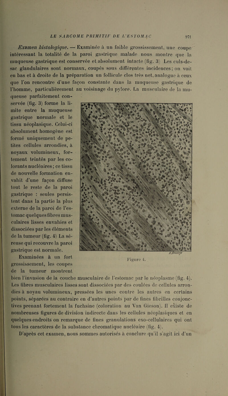 4 Examen histologique. — Examinée à un faible grossissement, une coupe intéressant la totalité de la paroi gastrique malade nous montre que la muqueuse gastrique est conservée et absolument intacte (fig. 3) Les culs-de- sac glandulaires sont normaux, coupés sous différentes incidences ; on voit en bas et à droite de la préparation un follicule clos très net, analogue à ceux que l’on rencontre d’une façon constante dans la muqueuse gastrique de l’homme, particulièrement au voisinage du pylore. La musculaire de la mu¬ queuse parfaitement con¬ servée (fig. 3) forme la li¬ mite entre la muqueuse gastrique normale et le tissu néoplasique. Celui-ci absolument homogène est formé uniquement de pe¬ tites cellules arrondies, à noyaux volumineux, for¬ tement teintés par les co¬ lorants nucléaires ; ce tissu de nouvelle formation en¬ vahit d’une façon diffuse tout le reste de la paroi gastrique : seules persis¬ tent dans la partie la plus externe de la paroi de l’es¬ tomac quelques fibres mus¬ culaires lisses envahies et dissociées par les éléments de la tumeur (fig. 4) La sé¬ reuse qui recouvre la paroi gastrique est normale. Examinées à un fort grossissement, les coupes de la tumeur montrent bien l’invasion de la couche musculaire de l’estomac par ie néoplasme (fig. 4). Les fibres musculaires lisses sont dissociées par des coulées de cellules arron¬ dies à noyau volumineux, pressées les unes contre les autres en certains points, séparées au contraire en d’autres points par de fines fibrilles conjonc¬ tives prenant fortement la fuchsine (coloration au Van Gieson). Il existe de nombreuses figures de division indirecte dans les cellules néoplasiques et en quelques endroits on remarque de fines granulations exo-cellulaires qui ont tous les caractères de la substance chromatique nucléaire (fig. 4). D’après cet examen, nous sommes autorisés à conclure qu’il s'agit ici d'un A&essf/r Figure 4.