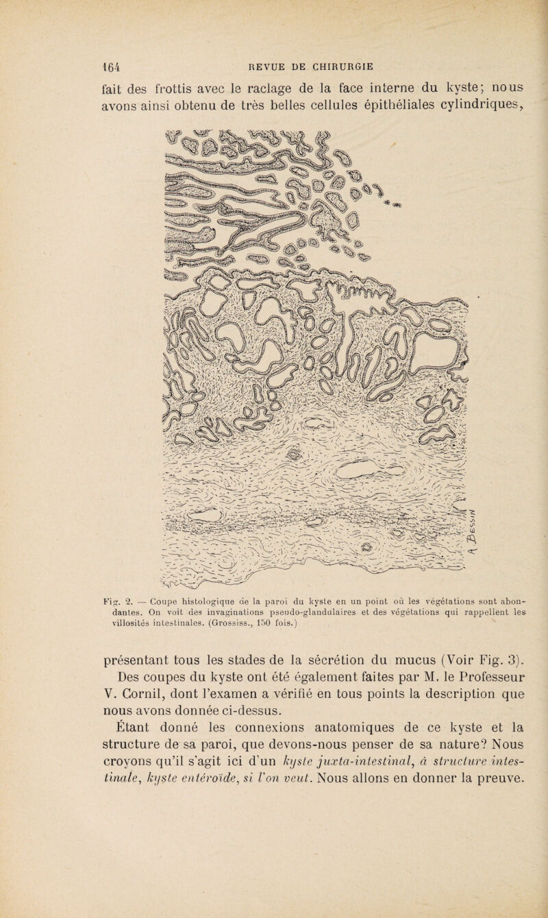 fait des frottis avec le raclage de la face interne du kyste; nous avons ainsi obtenu de très belles cellules épithéliales cylindriques, Fi^. 2. — Coupe histologique de la paroi du kyste en un point où les végétations sont abon¬ dantes. On voit des invaginations pseudo-glandulaires et des végétations qui rappellent les villosités intestinales. (Grossiss., 150 fois.) présentant tous les stades de la sécrétion du mucus (Voir Fig. 3). Des coupes du kyste ont été également faites par M, le Professeur V. Corail, dont l’examen a vérifié en tous points la description que nous avons donnée ci-dessus. Étant donné les connexions anatomiques de ce kyste et la structure de sa paroi, que devons-nous penser de sa nature? Nous croyons qu’il s’agit ici d’un kyste juxtci-intestinal, à structure intes¬ tinale, kyste entéroïde, si Von veut. Nous allons en donner la preuve.