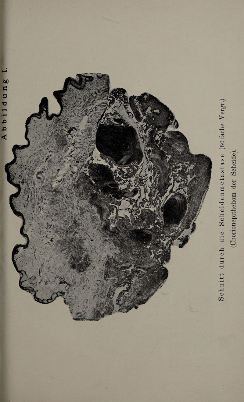 Abbildung Schnitt durch die Scheidenmetastase (60fache Vergr.) (Chorionepitheliom der Scheide).