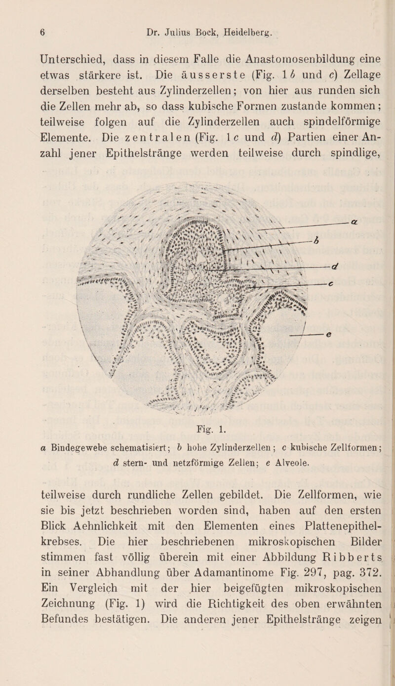 Unterschied, dass in diesem Falle die Anastomosenbildung eine etwas stärkere ist. Die äusserste (Fig. 16 und c) Zellage derselben besteht aus Zylinderzellen; von hier aus runden sich die Zellen mehr ab, so dass kubische Formen zustande kommen ; teilweise folgen auf die Zylinderzellen auch spindelförmige Elemente. Die z en tr alen (Fig. 1 c und d) Partien einer An¬ zahl jener Epithelstränge werden teilweise durch spindlige, Fig. 1. a Bindegewebe schematisiert; b hohe Zylinderzellen ; c kubische Zelltormen; d stern- und netzförmige Zellen; e Alveole. teilweise durch rundliche Zellen gebildet. Die Zellformen, wie sie bis jetzt beschrieben worden sind, haben auf den ersten Blick Aehnlichkeit mit den Elementen eines Plattenepithel¬ krebses. Die hier beschriebenen mikroskopischen Bilder stimmen fast völlig überein mit einer Abbildung Ribberts in seiner Abhandlung über Adamantinome Fig. 297, pag. 372. Ein Vergleich mit der hier beigefügten mikroskopischen Zeichnung (Fig. 1) wird die Richtigkeit des oben erwähnten Befundes bestätigen. Die anderen jener Epithelstränge zeigen j