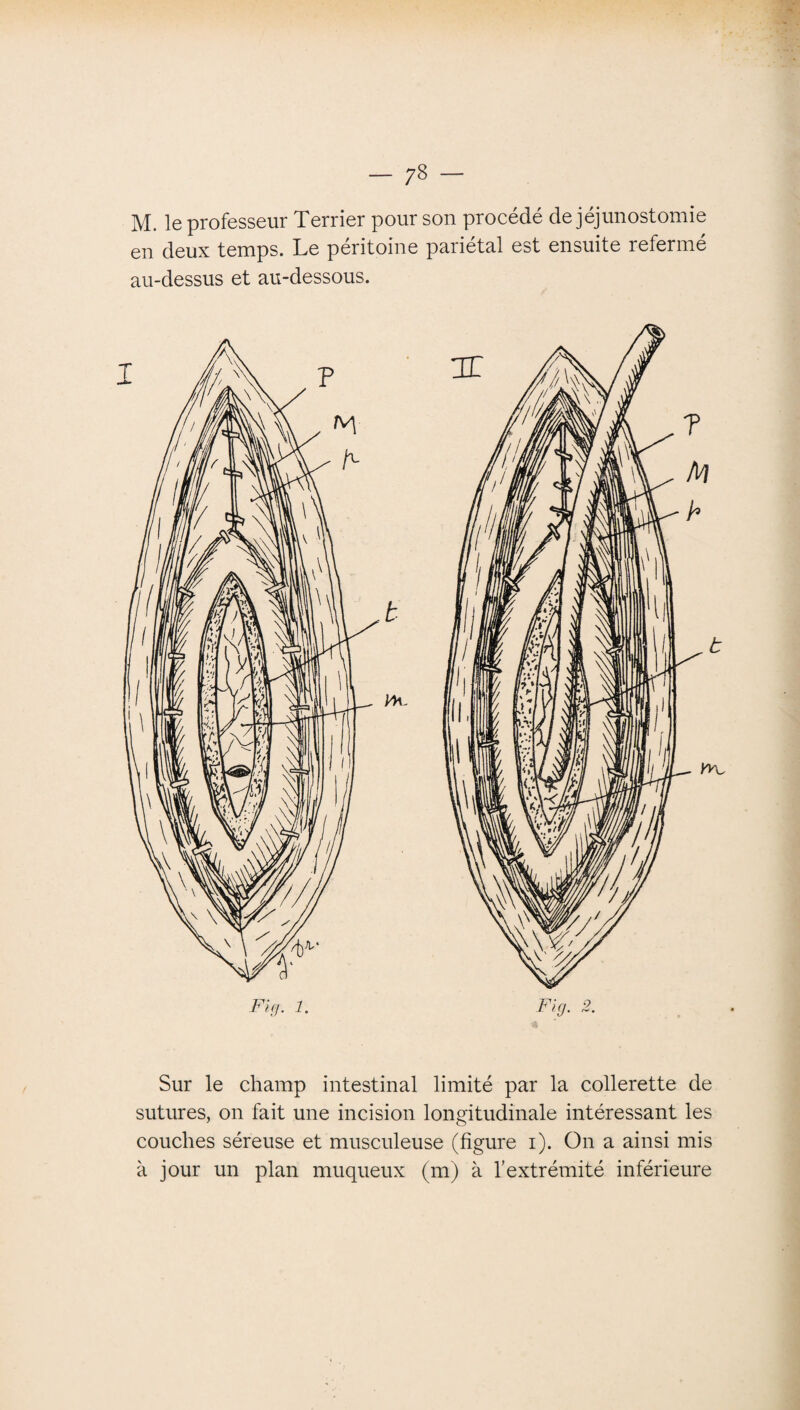 - 73 - M. le professeur Terrier pour son procédé de jéjunostomie en deux temps. Le péritoine pariétal est ensuite refermé au-dessus et au-dessous. Sur le champ intestinal limité par la collerette de sutures, on fait une incision longitudinale intéressant les couches séreuse et musculeuse (figure i). On a ainsi mis