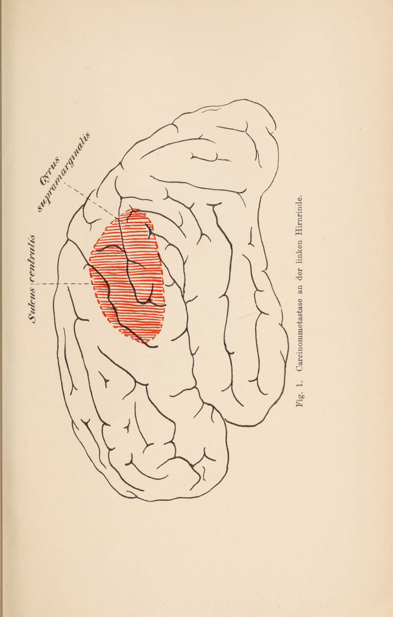 Sulcus i centralis rH bi) • rH Carcinommetastase an der linken Hirnrinde.