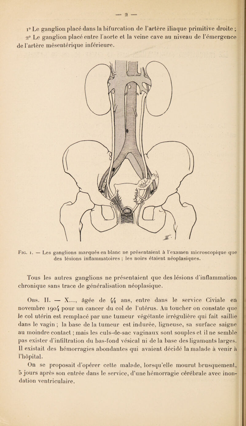 i° Le ganglion placé dans la bifurcation de l’artère iliaque primitive droite ; 2° Le ganglion placé entre l'aorte et la veine cave au niveau de l’émergence de l’artère mésentérique inférieure. Fig. i. — Les ganglions marqués en blanc ne présentaient à l’examen microscopique que des lésions inflammatoires ; les noirs étaient néoplasiques. Tous les autres ganglions ne présentaient que des lésions d’inflammation chronique sans trace de généralisation néoplasique. Obs. IL — X..., âgée de 44 ans, entre dans le service Civiale en novembre 1904 pour un cancer du col de l’utérus. Au toucher on constate que le col utérin est remplacé par une tumeur végétante irrégulière qui fait saillie dans le vagin ; la base de la tumeur est indurée, ligneuse, sa surface saigne au moindre contact ; mais les culs-de-sac vaginaux sont souples et il ne semble pas exister d’infiltration du bas-fond vésical ni delà base des ligaments larges. Il existait des hémorragies abondantes qui avaient décidé la malade à venir à l’hôpital. On se proposait d’opérer cette malade, lorsqu’elle mourut brusquement, 5 jours après son entrée dans le service, d’une hémorragie cérébrale avec inon¬ dation ventriculaire.