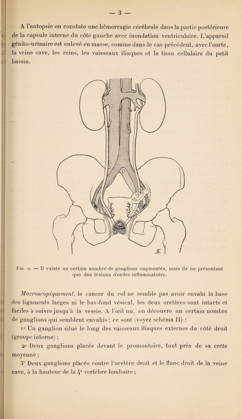 A l’autopsie on constate une hémorragie cérébrale dans la partie postérieure de la capsule interne du côté gauche avec inondation ventriculaire. L’appareil génito-urinaire est enlevé en masse, comme dans le cas précédent, avec l’aorte, la veine cave, les reins, les vaisseaux iliaques et le tissu cellulaire du petit bassin. Fig. 2. — Il existe un certain nombre de ganglions augmentés, mais ils ne présentent que des lésions d’ordre inflammatoire. Macroscopiquement, le cancer du col ne semble pas avoir envahi la base des ligaments larges ni le bas-fond vésical, les deux uretères sont intacts et faciles à suivre jusqu’à la vessie. A l’œil nu, on découvre un certain nombre de ganglions qui semblent envahis ; ce sont (voyez schéma II) : i° Un ganglion situé le long des vaisseaux iliaques externes du côté droit (groupe interne) ; 2° Deux ganglions placés devant le promontoire, tout près de sa crête moyenne ; 3° Deux ganglions placés contre l’uretère droit et le flanc droit de la veine cave, à la hauteur de la 4 e vertèbre lombaire ;