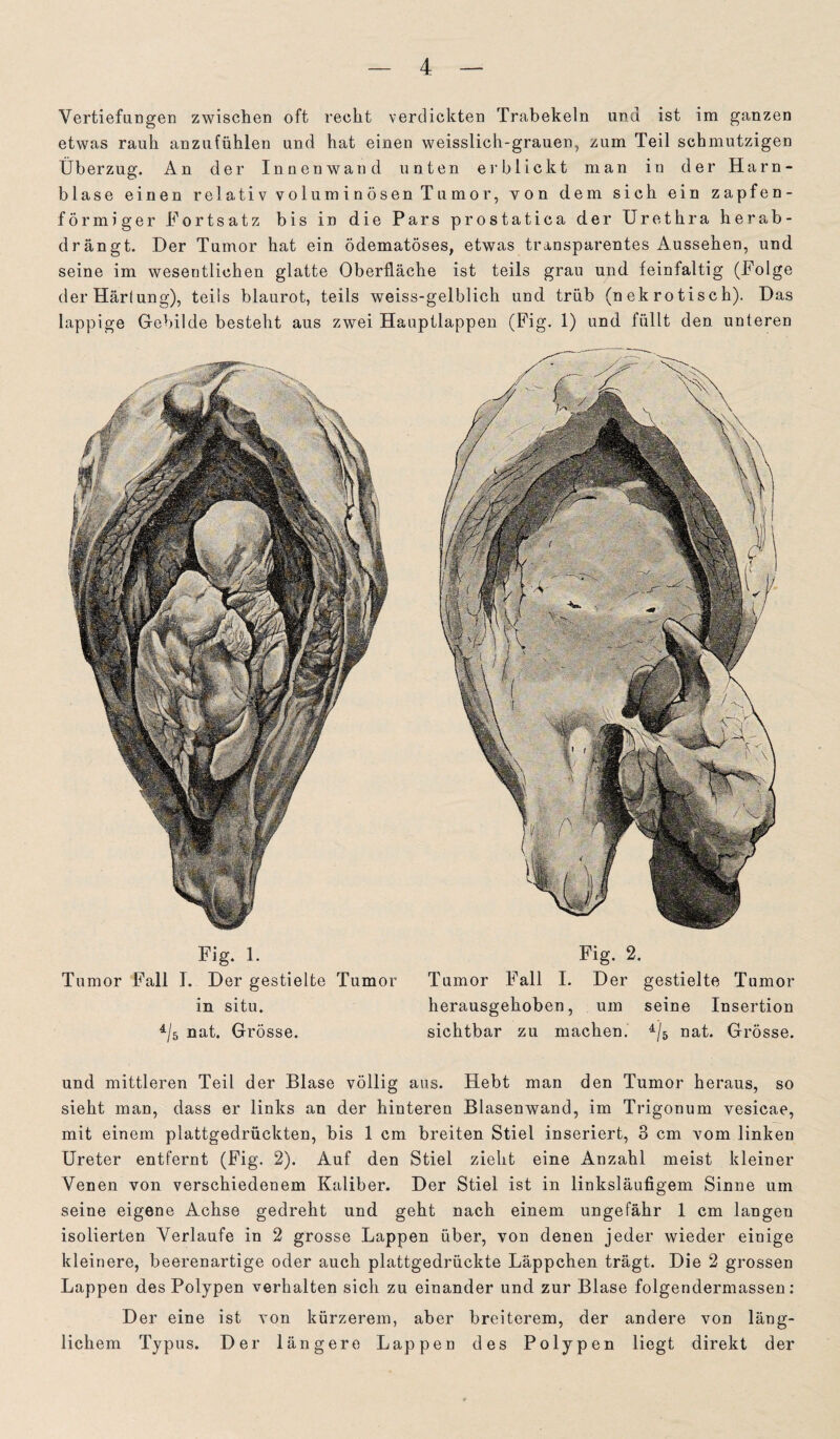 Vertiefungen zwischen oft recht verdickten Trabekeln und ist im ganzen etwas rauh anzufühlen und hat einen weisslich-grauen, zum Teil schmutzigen Überzug. An der Innenwand unten erblickt man in der Harn¬ blase einen relativ voluminösen Tumor, von dem sich ein zapfen¬ förmiger Fortsatz bis in die Pars prostatica der Urethra herab¬ drängt. Der Tumor hat ein ödematöses, etwas transparentes Aussehen, und seine im wesentlichen glatte Oberfläche ist teils grau und feinfaltig (Folge der Härtung), teils blaurot, teils weiss-gelblich und trüb (nekrotisch). Das lappige Gebilde besteht aus zwei Hauptlappen (Fig. 1) und füllt den unteren Fig. 1. Tumor Fall I. Der gestielte Tumor in situ. 4/5 nat. Grösse. Fig. 2. Tumor Fall I. Der gestielte Tumor herausgehoben, um seine Insertion sichtbar zu machen. 4/5 nat. Grösse. und mittleren Teil der Blase völlig aus. Hebt man den Tumor heraus, so sieht man, dass er links an der hinteren Blasenwand, im Trigonum vesicae, mit einem plattgedrückten, bis 1 cm breiten Stiel inseriert, 3 cm vom linken Ureter entfernt (Fig. 2). Auf den Stiel zieht eine Anzahl meist kleiner Venen von verschiedenem Kaliber. Der Stiel ist in linksläufigem Sinne um seine eigene Achse gedreht und geht nach einem ungefähr 1 cm langen isolierten Verlaufe in 2 grosse Lappen über, von denen jeder wieder einige kleinere, beerenartige oder auch plattgedrückte Läppchen trägt. Die 2 grossen Lappen des Polypen verhalten sich zu einander und zur Blase folgendermassen: Der eine ist von kürzerem, aber breiterem, der andere von läng¬ lichem Typus. Der längere Lappen des Polypen liegt direkt der