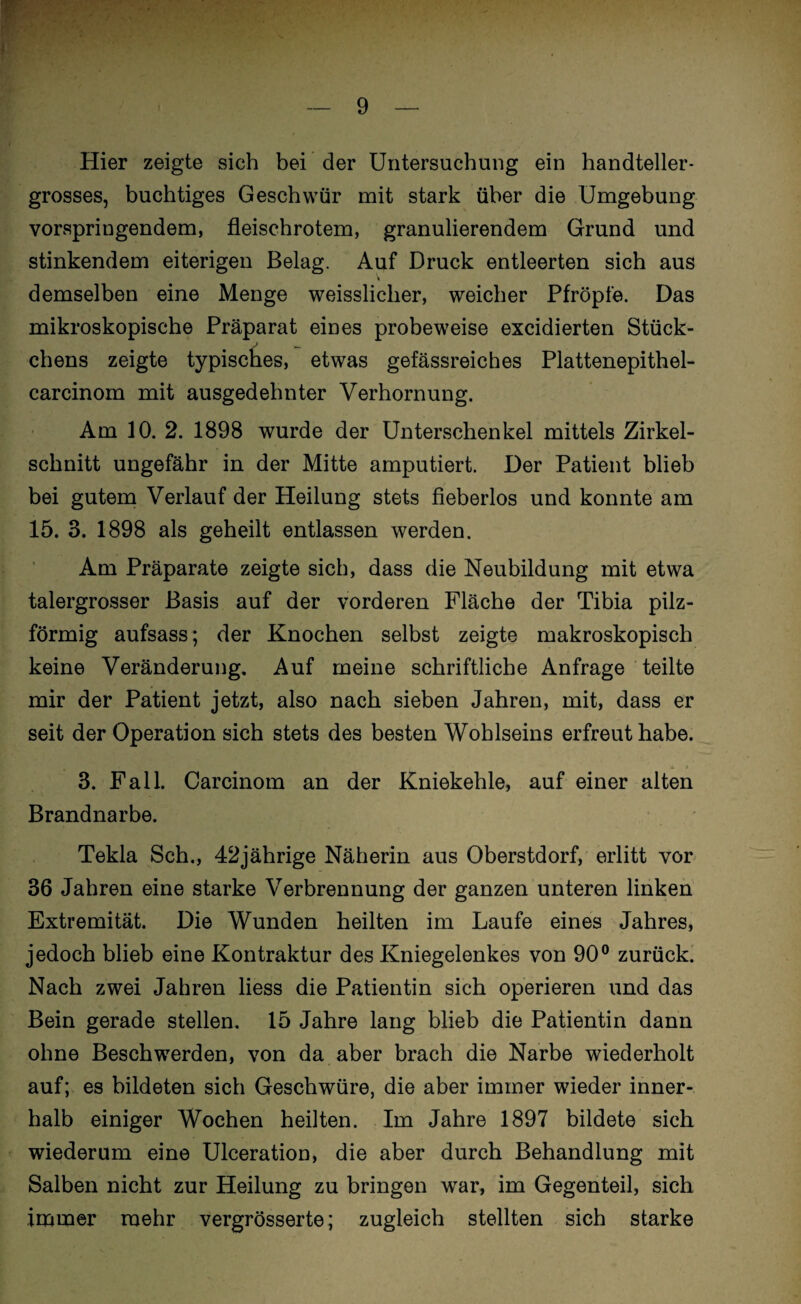 Hier zeigte sich bei der Untersuchung ein handteller¬ grosses, buchtiges Geschwür mit stark über die Umgebung vorspringendem, fleischrotem, granulierendem Grund und stinkendem eiterigen Belag. Auf Druck entleerten sich aus demselben eine Menge weisslicher, weicher Pfropfe. Das mikroskopische Präparat eines probeweise excidierten Stück¬ chens zeigte typisches, etwas gefässreiches Plattenepithel- carcinom mit ausgedehnter Verhornung. Am 10. 2. 1898 wurde der Unterschenkel mittels Zirkel¬ schnitt ungefähr in der Mitte amputiert. Der Patient blieb bei gutem Verlauf der Heilung stets fieberlos und konnte am 15. 3. 1898 als geheilt entlassen werden. Am Präparate zeigte sich, dass die Neubildung mit etwa talergrosser Basis auf der vorderen Fläche der Tibia pilz¬ förmig aufsass; der Knochen selbst zeigte makroskopisch keine Veränderung. Auf meine schriftliche Anfrage teilte mir der Patient jetzt, also nach sieben Jahren, mit, dass er seit der Operation sich stets des besten Wohlseins erfreut habe. /. i 3. Fall. Carcinom an der Kniekehle, auf einer alten Brandnarbe. Tekla Sch., 42jährige Näherin aus Oberstdorf, erlitt vor 36 Jahren eine starke Verbrennung der ganzen unteren linken Extremität. Die Wunden heilten im Laufe eines Jahres, jedoch blieb eine Kontraktur des Kniegelenkes von 90° zurück. Nach zwei Jahren Hess die Patientin sich operieren und das Bein gerade stellen. 15 Jahre lang blieb die Patientin dann ohne Beschwerden, von da aber brach die Narbe wiederholt auf; es bildeten sich Geschwüre, die aber immer wieder inner¬ halb einiger Wochen heilten. Im Jahre 1897 bildete sich wiederum eine Ulceration, die aber durch Behandlung mit Salben nicht zur Heilung zu bringen war, im Gegenteil, sich immer mehr vergrösserte; zugleich stellten sich starke