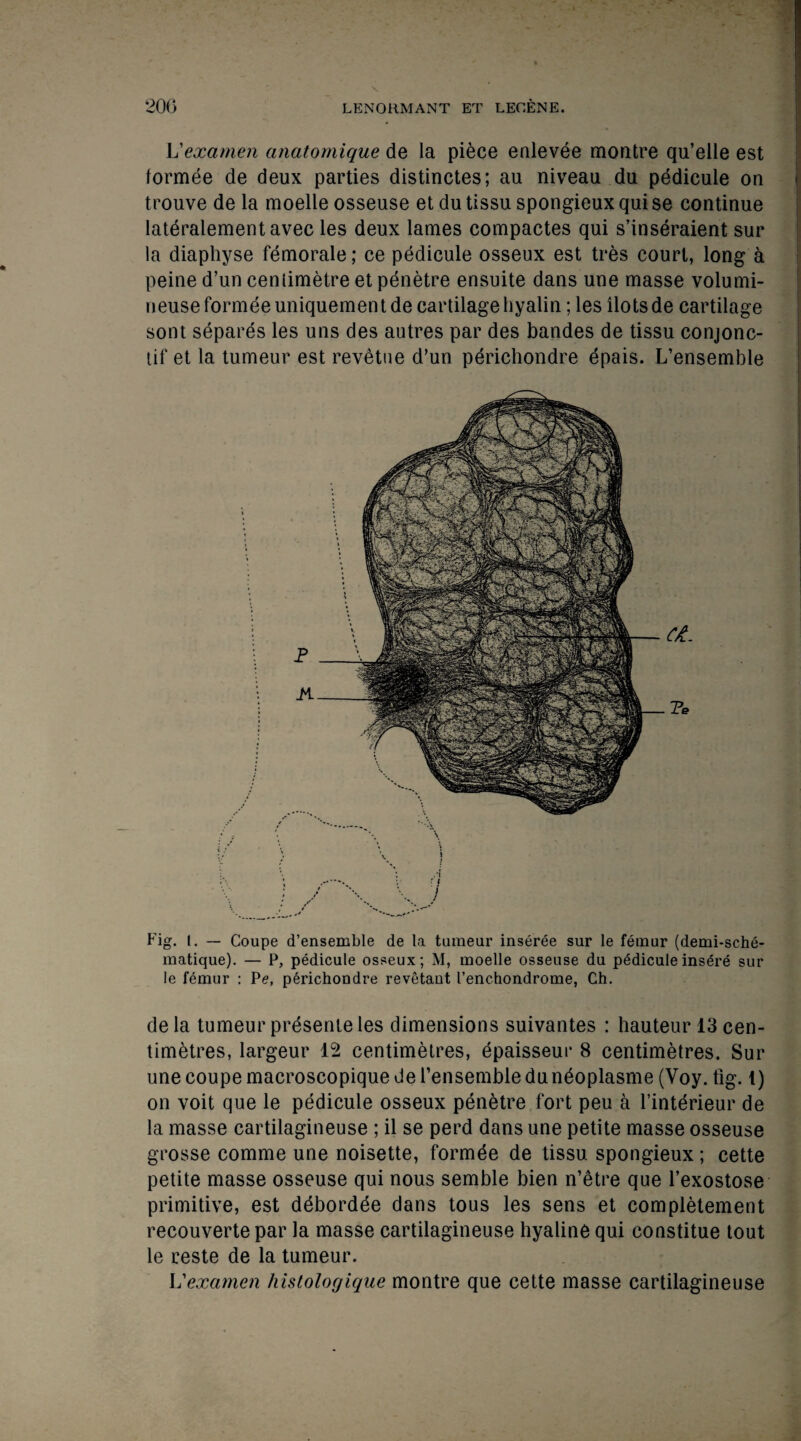 L'examen anatomique de la piece enlevee montre qu’elle est formee de deux parties distinctes; au niveau du pedicule on trouve de la moelle osseuse et du tissu spongieux qui se continue lateralementavec les deux lames compactes qui s’inseraient sur la diaphyse femorale; ce pedicule osseux est tres court, long a peine d’un centimetre et penetre ensuite dans une masse volumi- neuse formee uniquementde cartilage hyalin; les ilotsde cartilage sont separes les uns des autres par des bandes de tissu conjonc- tif et la tumeur est revetue d’un perichondre epais. L’ensemble Fig. l. — Coupe d’ensemble de la tumeur inseree sur le femur (demi-sche- matique). — P, pedicule osseux; M, moelle osseuse du pedicule insere sur le femur : P<?, perichondre revetant I’enchondrome, Ch. dela tumeur presente les dimensions suivantes : hauteur 13 cen¬ timetres, largeur 12 centimetres, epaisseui* 8 centimetres. Sur une coupe macroscopiquedel’ensembledundoplasme (Voy. tig. 1) on voit que le pedicule osseux penetre fort peu a l’interieur de la masse cartilagineuse ; il se perd dans une petite masse osseuse grosse comme une noisette, formee de tissu spongieux; cette petite masse osseuse qui nous semble bien n’etre que l’exostose primitive, est ddbordde dans tous les sens et completement recouvertepar la masse cartilagineuse hyaline qui constitue tout le reste de la tumeur. \j examen histologique montre que cette masse cartilagineuse