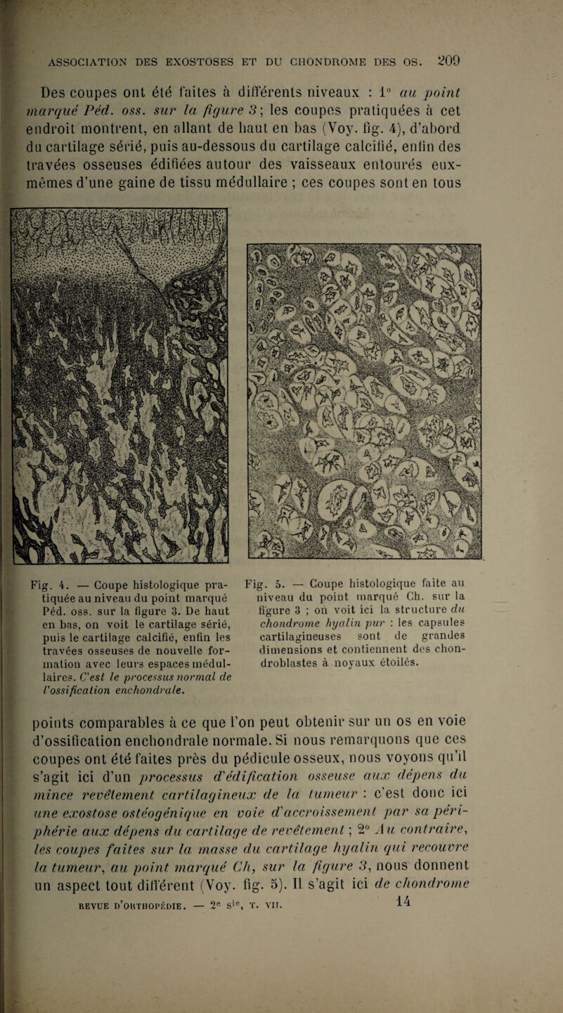 Des coupes ont ete faites a differents uiveaux : 1° au point marque Ped. oss. sur la figure 3; les coupes pratiquees a cet endroit montrent, en allant de liaut en bas (Voy. fig. 4), d’abord du cartilage serie, puis au-dessous du cartilage calcilie, enlin des travees osseuses edifiees autour des vaisseaux entoures eux- memes d’une gaine de tissu medullaire ; ces coupes sont en tous Fig. 4. — Coupe histologique pra- tiquee au niveau du point marque Ped. oss. sur la figure 3. De haut en bas, on voit le cartilage serie, puis le cartilage calcifie, enfin les travees osseuses de nouvelie for- mation avec leurs espaces medul- laires. C'est le processus normal de l'ossification enchondrale. Fig. 5. — Coupe histologique faite au niveau du point marque Ch. sur la figure 3 ; on voit ici la structure du chondrome hyalin pur : les capsules cartilagineuses sont de grandes dimensions et contiennent des chon- droblastes a noyaux etoiles. points comparables a ce que l’on peut obtenir sur un os en voie d’ossification enchondrale normale. Si nous remarquons que ces coupes ont ete faites pres du pedicule osseux, nous voyons qu’il s’agit ici d’un processus d'edification osseuse aux depens du mince revdlement cartilagineux de la tumeur : c’est done ici une exostose osteogenique en voie d'accroissement par sa peri- pherie aux depens du cartilage de revetcmenl; 2° Au contraire, les coupes faites sur la masse du cartilage hyalin qui recouvre la tumeur, au point marque Ch, sur la figure 3, nous donnent un aspect tout different (Voy. fig. 5). II s’agit ici de chondrome