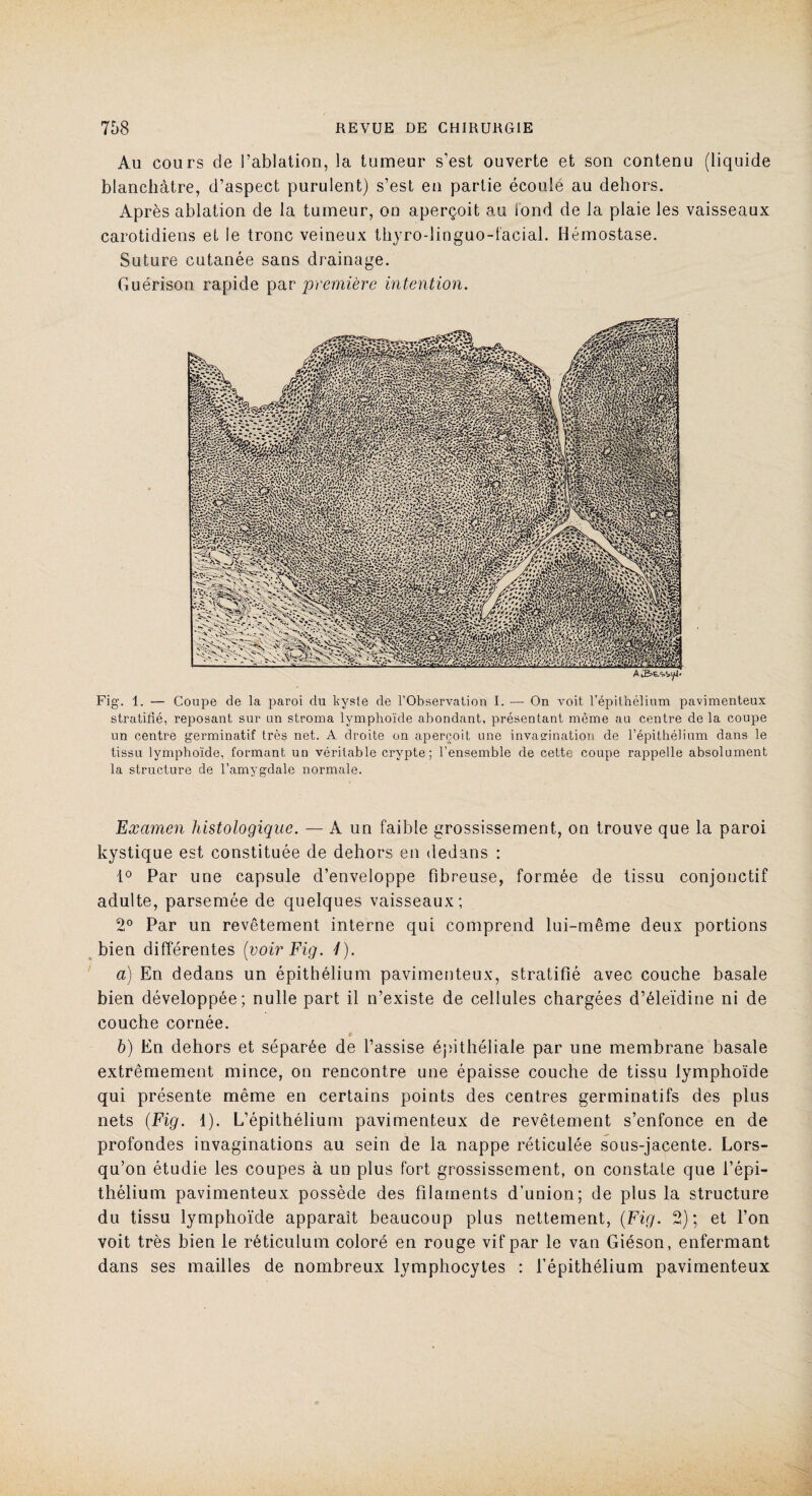 Au cours de l’ablation, la tumeur s’est ouverte et son contenu (liquide blanchâtre, d’aspect purulent) s’est en partie écoulé au dehors. Après ablation de la tumeur, on aperçoit au tond de la plaie les vaisseaux carotidiens et le tronc veineux thyro-linguo-facial. Hémostase. Suture cutanée sans drainage. Guérison rapide par première intention. Fig. 1. — Coupe de la paroi du kyste de l’Observation I. — On voit l’épithélium pavimenteux stratifié, reposant sur un stroma lymphoïde abondant, présentant même au centre de la coupe un centre germinatif très net. A droite on aperçoit une invagination de l’épithélium dans le tissu lymphoïde, formant un véritable crypte; l’ensemble de cette coupe rappelle absolument la structure de l’amygdale normale. Examen histologique. — A un faible grossissement, on trouve que la paroi kystique est constituée de dehors en dedans : i° Par une capsule d’enveloppe fibreuse, formée de tissu conjonctif adulte, parsemée de quelques vaisseaux; 2° Par un revêtement interne qui comprend lui-même deux portions bien différentes (voir Fig. 4). a) En dedans un épithélium pavimenteux, stratifié avec couche basale bien développée; nulle part il n’existe de cellules chargées d’éleïdine ni de couche cornée. h) En dehors et séparée de l’assise épithéliale par une membrane basale extrêmement mince, on rencontre une épaisse couche de tissu lymphoïde qui présente même en certains points des centres germinatifs des plus nets (Fig. 1). L’épithélium pavimenteux de revêtement s’enfonce en de profondes invaginations au sein de la nappe réticulée sous-jacente. Lors¬ qu’on étudie les coupes à un plus fort grossissement, on constate que l’épi¬ thélium pavimenteux possède des filaments d'union; de plus la structure du tissu lymphoïde apparaît beaucoup plus nettement, (Fig. 2); et l’on voit très bien le réticulum coloré en rouge vif par le van Giéson, enfermant dans ses mailles de nombreux lymphocytes : l’épithélium pavimenteux