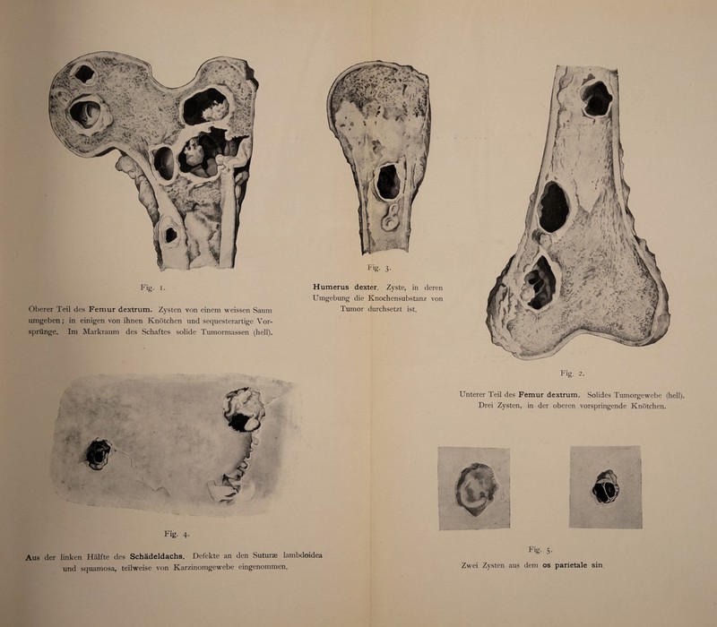 Humerus dexter. Zyste, in deren Umgebung die Knochensubstanz von Tumor durchsetzt ist. Oberer Teil des Femur dextrum. Zysten von einem weissen Saum umgeben; in einigen von ihnen Knötchen und sequesterartige Vor¬ sprünge. Im Markraum des Schaftes solide Tumormassen (hell). 3- Fig. 4. Fig. 2. Unterer Teil des Femur dextrum. Solides Tumorgewebe (hell). Drei Zysten, in der oberen vorspringende Knötchen. Fig. 5- Zwei Zysten aus dem os parietale sin. Aus der linken Hälfte des Schädeldachs. Defekte an den Suturae lambdoidea und squamosa, teilweise von Karzinomgewebe eingenommen.
