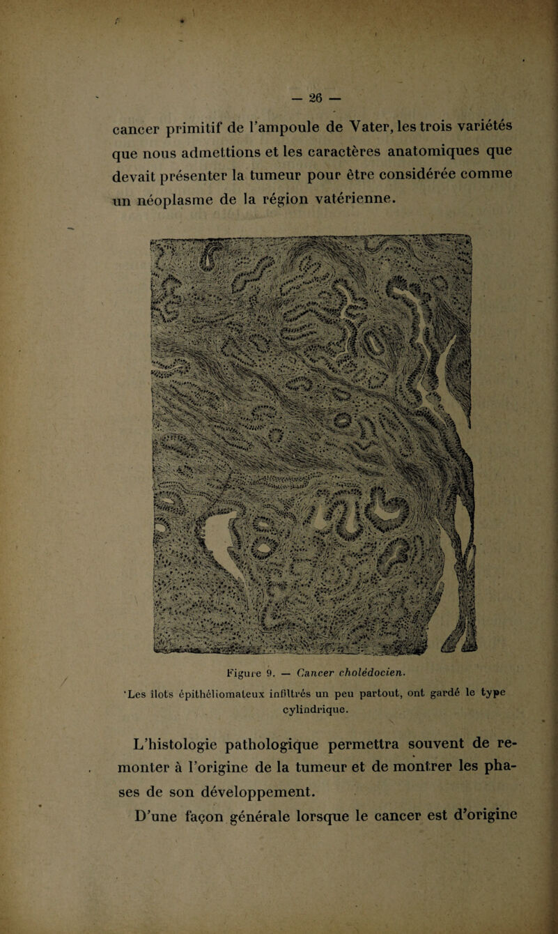 ■ ■;rr-‘ü'- •' -■- / viî^w,;UA ;v;^ -.Y , * ; -V vi.-(-.—•-•:> ;<z & I:;#-,. **»'«*  $ 'ÿ*3 l:m apvr' .♦■♦ *■ •••„: *.V.! .» -^HV^ -s :^. -O • . **< . •.' V 4. cancer primitif de l’ampoule de Vater, les trois variétés que nous admettions et les caractères anatomiques que devait présenter la tumeur pour être considérée comme un néoplasme de la région vatérienne. Figure 9. — Cancer cholédocien. 'Les îlots épithéUomaleux infiltrés un peu partout, ont gardé le type cylindrique. L’histologie pathologique permettra souvent de re- * monter à l’origine de la tumeur et de montrer les pha¬ ses de son développement. D’une façon générale lorsque le cancer est d’origine