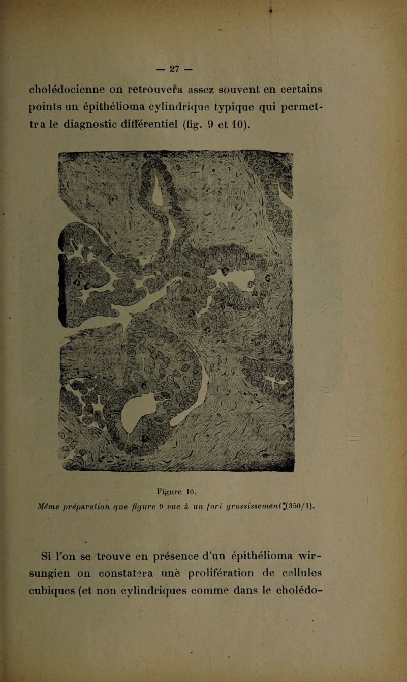 cholédocienne on retrouvera assez souvent en certains points un épithélioma cylindrique typique qui permet¬ tra le diagnostic différentiel (fig. 9 et 10). Figure 10. Même préparation que fiqure 9 vue à un fort qrossissemenlmK{SoO/l). Si Ton se trouve en présence d’un épithélioma wir- sungien on constatera unè prolifération de cellules cubiques (et non cylindriques comme dans le cholédo-