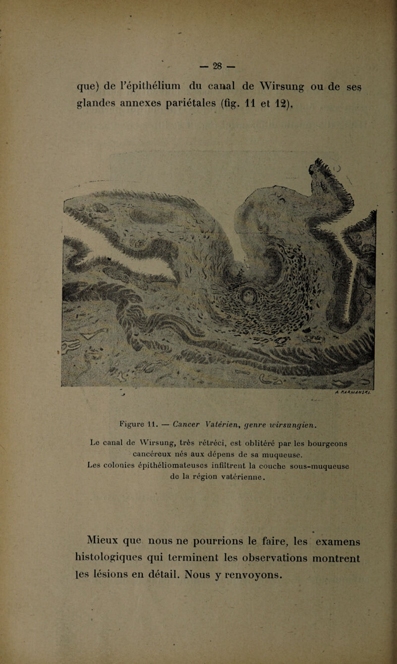 que) de l’épithélium du canal de Wirsung ou de ses glandes annexes pariétales (fîg. 11 et 12), ■ r’v / ■ ■ f - • ' '• ’ -V. . “Vr , VA ^ *» • : : *r*; • •' ■ .  • * ' 'r ■-1 - .•. Figure 11. — Cancer Vatérien, genre wirsungien. Le canal de Wirsung, très rétréci, est oblitéré par les bourgeons cancéreux nés aux dépens de sa muqueuse. Les colonies épithéliomateuscs infiltrent la couche sous-muqueuse de la région vatérienne. Mieux que nous ne pourrions le faire, les examens histologiques qui terminent les observations montrent les lésions en détail. Nous y renvoyons.