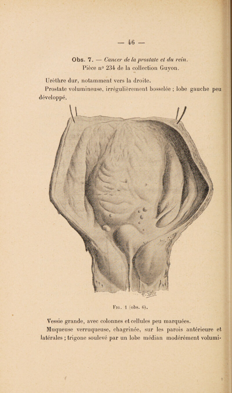 Fig. 1 (obs. 6). Vessie grande, avec colonnes et cellules peu marquées. Muqueuse verruqueuse, chagrinée, sur les parois antérieure et latérales ; trigone soulevé par un lobe médian modérément volumi- Obs. 7. — Cancer delà prostate et du rein. Pièce n° 234 de la collection Guyon. Urèthre dur, notamment vers la droite. Prostate volumineuse, irrégulièrement bosselée ; lobe gauche peu développé.