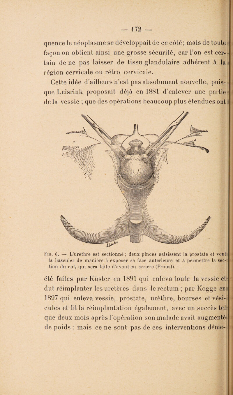 *72 — quence le néoplasme se développait de ce côté ; mais de toute façon on obtient ainsi une grosse sécurité, car l’on est cer¬ tain de ne pas laisser de tissu glandulaire adhérent à la région cervicale ou rétro cervicale. Cette idée d’ailleurs n’est pas absolument nouvelle, puis¬ que Leisrink proposait déjà en 1881 d’enlever une partie de la vessie ; que des opérations beaucoup plus étendues ont Fig. 6. — L’urèthre est sectionné ; deux pinces saisissent la prostate et vont la basculer de manière à exposer sa face antérieure et à permettre la sec¬ tion du col, qui sera faite d’avant en arrière (Proust). été faites par Küster en 1891 qui enleva toute la vessie et dut réimplanter les uretères dans le rectum ; par Kogge en 1897 qui enleva vessie, prostate, urèthre, bourses et vési¬ cules et fît la réimplantation également, avec un succès tel que deux mois après l’opération son malade avait augmenté' de poids : mais ce ne sont pas de ces interventions déme-