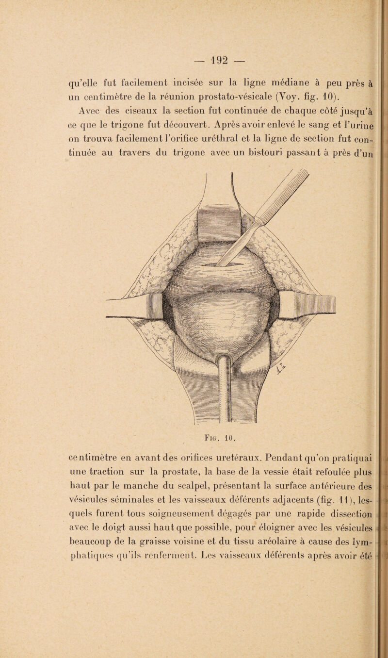 qu’elle fut facilement incisée sur la ligne médiane à peu près à un centimètre de la réunion prostato-vésicale (Voy. fig. 10). Avec des ciseaux la section fut continuée de chaque côté jusqu’à ce que le trigone fut découvert. Après avoir enlevé le sang et l’urine on trouva facilement l’orifice uréthral et la ligne de section fut con¬ tinuée au travers du trigone avec un histouri passant à près d’un Fig. 10. centimètre en avant des orifices urétéraux. Pendant qu’on pratiquai une traction sur la prostate, la base de la vessie était refoulée plus haut par le manche du scalpel, présentant la surface antérieure des vésicules séminales et les vaisseaux déférents adjacents (fig. 11), les¬ quels furent tous soigneusement dégagés par une rapide dissection avec le doigt aussi haut que possible, pour éloigner avec les vésicules beaucoup de la graisse voisine et du tissu aréolaire à cause des lym¬ phatiques qu’ils renferment. Les vaisseaux déférents après avoir été