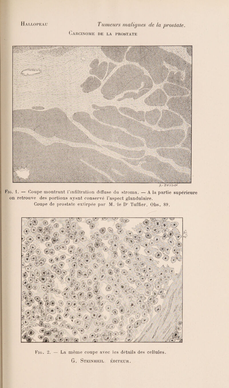 Hallopeau Carcinome Tumeurs malignes de la prostate. DE LA PROSTATE Fig. 1. — Coupe montrant l’infiltration diffuse du stroma. — A la partie supérieure on retrouve des portions ayant conservé l’aspect glandulaire. Coupe de prostate extirpée par M. le Dr Tuffier. Obs. 89. Fig. 2. — La même coupe avec les détails des cellules. G. Steinheil. éditeur.