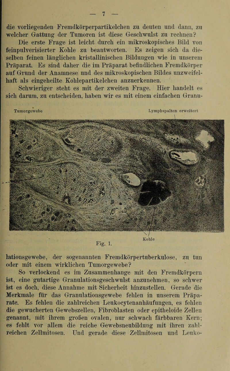 die vorliegenden Fremdkörperpartikelchen zu deuten und dann, zu welcher Gattung der Tumoren ist diese Geschwulst zu rechnen? Die erste Frage ist leicht durch ein mikroskopisches Bild von feinpulverisierter Kohle zu beantworten. Es zeigen sich da die¬ selben feinen länglichen kristallinischen Bildungen wie in unserem Präparat. Es sind daher die im Präparat befindlichen Fremdkörper auf Grund der Anamnese und des mikroskopischen Bildes unzweifel¬ haft als eingeheilte Kohlepartikelchen anzuerkennen. Schwieriger steht es mit der zweiten Frage. Hier handelt es sich darum, zu entscheiden, haben wir es mit einem einfachen Granu- Tumorgewebe Lympb spalten erweitert Kohle Big. 1. lationsgewebe, der sogenannten Fremdkörpertuberkulose, zu tun oder mit einem wirklichen Tumorgewebe? So verlockend es im Zusammenhänge mit den Fremdkörpern ist, eine gutartige Granulationsgeschwulst anzunehmen, so schwer ist es doch, diese Annahme mit Sicherheit hinzustellen. Gerade die Merkmale für das Granulationsgewebe fehlen in unserem Präpa¬ rate. Es fehlen die zahlreichen Leukocytenanhäufungen, es fehlen die gewucherten Gewebszellen, Fibroblasten oder epitlieloide Zellen genannt, mit ihrem großen ovalen, nur schwach färbbaren Kern; es fehlt vor allem die reiche Gewebsneubildung mit ihren zahl¬ reichen Zellmitosen. Und gerade diese Zellmitosen und Leuko-