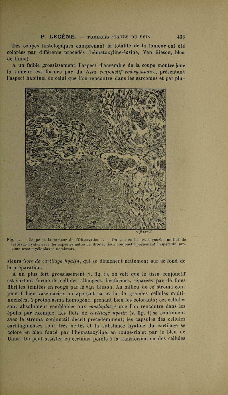 Des coupes histologiques comprenant la totalité de la tumeur ont été colorées par différents procédés (hématoxyline-éosine, Van Gieson, bleu de Unna). A un faible grossissement, l’aspect, d’ensemble de la coupe montre jque la tumeur est formée par du tissu conjonctif embryonnaire, présentant l'aspect habituel de celui que l’on rencontre dans les sarcomes et par plu- Fi. 1. — Coupe de la tumeur de l’Observation I. — On voit en bas et à gauche un ilôt de cartilage hyalin avec des capsules nettes : à droite, tissu conjonctif présentant l’aspect du sar¬ come avec mvéloplaxes nombreux. sieurs îlots de cartilage hyalin, qui se détachent nettement sur le fond de la préparation. A un plus fort grossissement (v. fig. 1), on voit que le tissu conjonctif est surtout formé de cellules allongées, fusiformes, séparées par de fines fibrilles teintées en rouge par le van Gieson. Au milieu de ce' stroma con¬ jonctif bien vascularisé, on aperçoit çà et là de grandes cellules multi- nucléées, à protoplasma homogène, prenant bien les colorants; ces cellules sont absolument semblables aux myéloplaxcs que l’on rencontre dans les épulis par exemple. Les îlots de cartilage hyalin (v. fig. 1) se continuent avec le stroma conjonctif décrit précédemment; les capsules des cellules cartilagineuses sont très nettes et la substance hyaline du cartilage se colore en bleu foncé par l’bématoxyline, en rouge-violet par le bleu de Unna. On peut assister en certains points à la transformation des cellules
