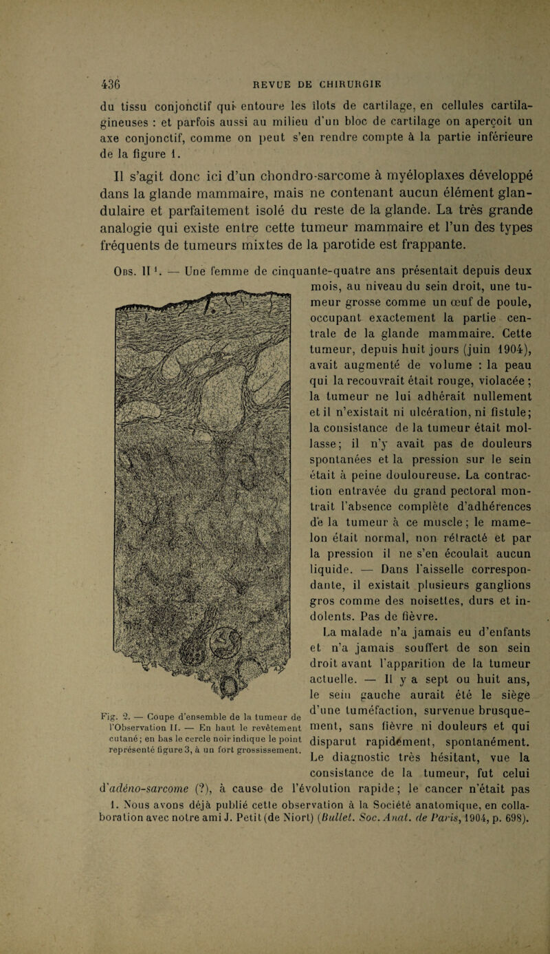 du tissu conjonctif qui' entoure les îlots de cartilage, en cellules cartila¬ gineuses : et parfois aussi au milieu d'un bloc de cartilage on aperçoit un axe conjonctif, comme on peut s’en rendre compte à la partie inférieure de la figure 1. Il s’agit donc ici d’un chondro-sarcome à myéloplaxes développé dans la glande mammaire, mais ne contenant aucun élément glan¬ dulaire et parfaitement isolé du reste de la glande. La très grande analogie qui existe entre cette tumeur mammaire et l’un des types fréquents de tumeurs mixtes de la parotide est frappante. Obs. 111. — Une femme de cinquante-quatre ans présentait depuis deux mois, au niveau du sein droit, une tu¬ meur grosse comme un œuf de poule, occupant exactement la partie cen¬ trale de la glande mammaire. Cette tumeur, depuis huit jours (juin 1904), avait augmenté de volume : la peau qui la recouvrait était rouge, violacée; la tumeur ne lui adhérait nullement et il n’existait ni ulcération, ni fistule; la consistance de la tumeur était mol¬ lasse; il n’y avait pas de douleurs spontanées et la pression sur le sein était à peine douloureuse. La contrac¬ tion entravée du grand pectoral mon¬ trait l’absence complète d’adhérences dé la tumeur à ce muscle; le mame¬ lon était normal, non rétracté et par la pression il ne s’en écoulait aucun liquide. — Dans l'aisselle correspon¬ dante, il existait plusieurs ganglions gros comme des noisettes, durs et in¬ dolents. Pas de fièvre. La malade n’a jamais eu d’enfants et n’a jamais souffert de son sein droit avant l'apparition de la tumeur actuelle. — Il y a sept ou huit ans, le sein gauche aurait été le siège n „ ,, ,, , , , , d’une tuméfaction, survenue brusque- rig. ‘2. — Coupe d ensemble de la tumeur de ’ n l’Observation II. — En haut le revêtement ment, sans fièvre lîi douleurs et qui cutané; en bas le cercle noir indique le point disparut rapidement, spontanément, représenté figure 3, à un fort grossissement. . , ,r Le diagnostic très hésitant, vue la consistance de la tumeur, fut celui d'adénosarcome (?), à cause de l’évolution rapide; le cancer n’était pas 1. Nous avons déjà publié cette observation à la Société anatomique, en colla¬ boration avec notre ami J. Petit (de Niort) (Buliet. Soc.Anat. de Paris, 1904, p. 698).