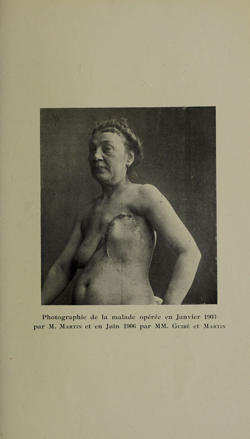 Photographie de la malade opérée en Janvier par M. Martin et en Juin 1906 par MM. Guibé et 1903 Martin