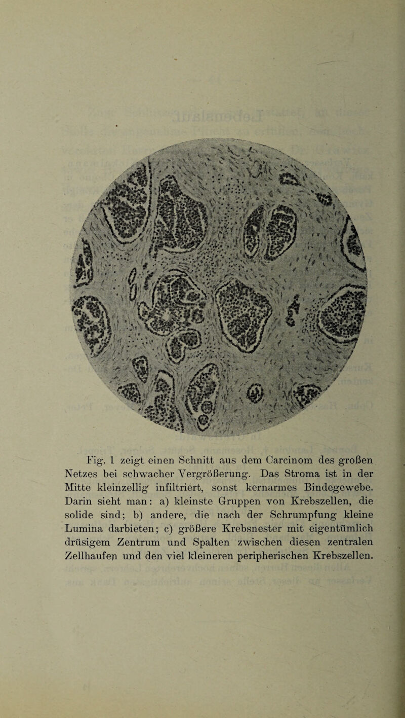 Netzes bei schwacher Vergrößerung. Das Stroma ist in der Mitte kleinzellig infiltriert, sonst kernarmes Bindegewebe. Darin sieht man: a) kleinste Gruppen von Krebszellen, die solide sind; b) andere, die nach der Schrumpfung kleine Lumina darbieten; c) größere Krebsnester mit eigentümlich drüsigem Zentrum und Spalten zwischen diesen zentralen Zellhaufeji und den viel kleineren peripherischen Krebszellen.