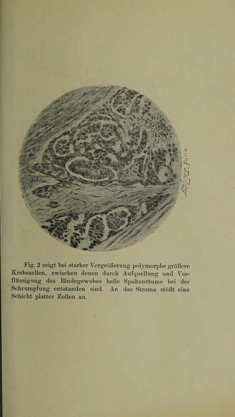 Krebszellen, zwischen denen durch Aufquellung und Ver¬ flüssigung des Bindegewebes helle Spaltenräume bei der Schrumpfung entstanden sind. An das Stroma stößt eine Schicht platter Zellen an.