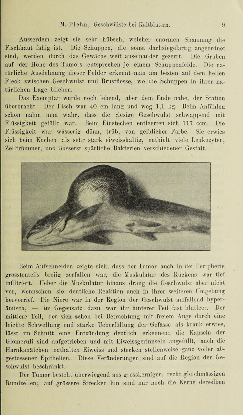 Ausserdem zeigt sie sehr hübsch, welcher enormen Spannung die Fischhaut fähig ist. Die Schuppen, die sonst dachziegelartig angeordnet sind, werden durch das Gewächs w7eit auseinander gezerrt. Die Gruben auf der Höhe des Tumors entsprechen je einem Schuppenfelde. Die na¬ türliche Ausdehnung dieser Felder erkennt man am besten auf dem hellen Fleck zwischen Geschwulst und Brustflosse, wo die Schuppen in ihrer na¬ türlichen Lage blieben. Das Exemplar wurde noch lebend, aber dem Ende nahe, der Station überbracht. Der Fisch war 40 cm lang und wog 1,1 kg. Beim Anfühlen schon nahm man wahr, dass die riesige Geschwulst schwappend mit Flüssigkeit gefüllt war. Beim Einstechen entleerten sich 117 ccm. Die Flüssigkeit war wässerig dünn, trüb, von gelblicher Farbe. Sie erwies sich beim Kochen als sehr stark eiweisshaltig, enthielt viele Leukozyten, Zelltrümmer, und äusserst spärliche Bakterien verschiedener Gestalt. Beim Aufschneiden zeigte sich, dass der Tumor auch in der Peripherie grösstenteils breiig zerfallen war, die Muskulatur des Rückens war tief infiltriert. Ueber die Muskulatur hinaus drang die Geschwulst aber nicht vor, wennschon sie deutliche Reaktion auch in ihrer weiteren Umgebung hervorrief. Die Niere war in der Region der Geschwulst auffallend hyper- ämisch, — im Gegensatz dazu war ihr hinterer Teil fast blutleer. Der mittlere Teil, der sich schon bei Betrachtung mit freiem Auge durch eine leichte Schwellung und starke Ueberfüllung der Gefässe als krank erwies, lässt im Schnitt eine Entzündung deutlich erkennen; die Kapseln der Glomeruli sind aufgetrieben und mit Eiweissgerinnseln angefüllt, auch die Harnkanälchen enthalten Eiweiss und stecken stellenweise ganz voller ab- gestossener Epithelien. Diese Veränderungen sind auf die Region der Ge¬ schwulst beschränkt. Der Tumor besteht überwiegend aus grosskernigen, recht gleichmässigen Rundzellen; auf grössere Strecken hin sind nur noch die Kerne derselben