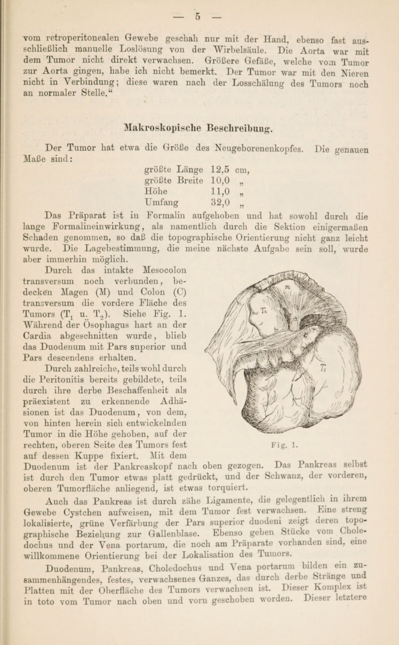 vom retroperitonealen Gewebe geschah nur mit der Hand, ebenso fast aus¬ schließlich manuelle Loslösung von der Wirbelsäule. Die Aorta war mit dem Tumor nicht direkt verwachsen. Größere Gefäße, welche vom Tumor zur Aorta gingen, habe ich nicht bemerkt. Der Tumor war mit den Nieren nicht in Verbindung; diese waren nach der Losschälung des Tumors noch an normaler Stelle.“ Makroskopische Beschreibung. Der Tumor hat etwa die Größe des Neugeborenenkopfes. Die genauen Maße sind: größte Länge 12,5 cm, größte Breite 10,0 „ Höhe 11,0 „ Umfang 32,0 „ Das Präparat ist in Formalin aufgehoben und hat sowohl durch die lange Formalineinwirkung, als namentlich durch die Sektion einigermaßen Schaden genommen, so daß die topographische Orientierung nicht ganz leicht wurde. Die Lagebestimmung, die meiue nächste Aufgabe sein soll, wurde aber immerhin möglich. Durch das intakte Mesocolon transversum noch verbunden, be¬ decken Magen (M) und Colon (C) transversum die vordere Fläche des Tumors (Tj u. T2). Siehe Fig. 1. Während der Ösophagus hart an der Cardia abgeschnitten wurde, blieb das Duodenum mit Pars sujDerior und Pars descendens erhalten. Durch zahlreiche, teils wohl durch die Peritonitis bereits gebildete, teils durch ihre derbe Beschaffenheit als präexistent zu erkennende Adhä¬ sionen ist das Duodenum, von dem, von hinten herein sich entwickelnden Tumor in die Höhe gehoben, auf der rechten, oberen Seite des Tumors fest Fig. 1. auf dessen Kuppe fixiert. Mit dem Duodenum ist der Pankreaskopf nach oben gezogen. Das Pankreas selbst ist durch den Tumor etwas platt gedrückt, und der Schwanz, der vorderen, oberen Tumorfläche anliegend, ist etwas torquiert. Auch das Pankreas ist durch zähe Ligamente, die gelegentlieh in ihrem Gewebe Cystchen aufweisen, mit dem Tumor fest verwachsen, hine streng lokalisierte, grüne Verfärbung der Pars superior duodeni zeigt deien topo¬ graphische Beziehung zur Gallenblase. Ebenso geben Stücke \om Chole- dochus und der Vena portarum, die noch am Präparate vorhanden sind, eine willkommene Orientierung bei (1er Lokalisation des lumors. Duodenum, Pankreas, Choledochus und \ ena portarum bilden ein zu¬ sammenhängendes, festes, verwachsenes Ganzes, das durch dcibe Stränge un Platten mit der Oberfläche des Tumors verwachsen ist. Diesel .Komplex ist in toto vom Tumor nach oben und vorn geschoben worden. Dieser letztere