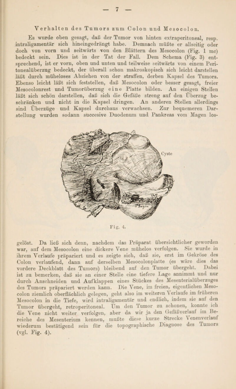 Verhalten des Tumors zum Colon und Mesocolon. Es wurde oben gesagt, daß der Tumor von hinten extraperitoneal, resp. intraligamentär sich hineingedrängt habe. Demnach müßte er allseitig oder doch von vorn und seitwärts von den Blättern des Mesocolon (Fig. 1 mc) bedeckt sein. Dies ist in der Tat der Fall. Dem Schema (Fig. 3) ent¬ sprechend, ist er vorn, oben und unten und teilweise seitwärts von einem Peri¬ tonealüberzug bedeckt, der überall schon makroskopisch sich leicht darstellen läßt durch müheloses Abziehen von der straffen, derben Kapsel des Tumors. Ebenso leicht läßt sich feststellen, daß Mesocolon oder besser gesagt., freier Mesocolonrest und Tumorüberzug eine Platte bilden. An einigen Stellen läßt sich schön darstellen, daß sich die Gefäße streng auf den Überzug be¬ schränken und nicht in die Kapsel dringen. An anderen Stellen allerdings sind Überzüge und Kapsel durchaus verwachsen. Zur bequemeren Dar¬ stellung wurden sodann succesive Duodenum und Pankreas vom Magen los- Fig. 4. gelöst. Da ließ sich denn, nachdem das Präparat übersichtlicher geworden war, auf dem Mesocolon eine dickere Vene mühelos verfolgen. Sie wurde in ihrem Verlaufe präpariert und es zeigte sich, daß sie, erst im Gekröse des Colon verlaufend, dann auf derselben Mesocolonplatte (es wäre dies das vordere Deckblatt des Tumors) bleibend auf den Tumor übergeht. Dabei ist zu bemerken, daß sie an einer Stelle eine tiefere Lage annimmt und nur durch Anschneiden und Aufklappen eines Stückes des Mesenterialüberzuges des Tumors präpariert werden kann. Die Vene, im freien, eigentlichen Meso¬ colon ziemlich oberflächlich gelegen, geht also im weiteren \ erlaufe im früheren Mesocolon in die Tiefe, wird intraligamentär und endlich, indem sie auf den Tumor übergeht, retroperitoneal. Um den Tumor zu schonen, konnte ich die Vene nicht weiter verfolgen, aber da wir ja den Gefäßverlauf im be¬ reiche des Mesenterium kennen, mußte diese kurze Strecke \enemeilauf wiederum bestätigend sein für die topographische Diagnose des l umors (vgl. Fig. 4).