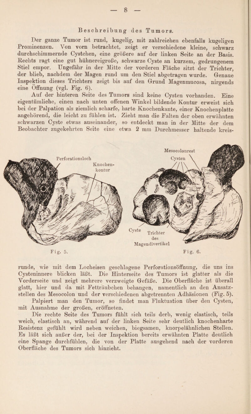 Beschreibung des Tumors. Der ganze Tumor ist rund, kugelig, mit zahlreichen ebenfalls kugeligen Prominenzen. Von vorn betrachtet, zeigt er verschiedene kleine, schwarz durchschimmernde Cystchen, eine größere auf der linken Seite an der Basis. Rechts ragt eine gut hühnereigroße, schwarze Cyste an kurzem, gedrungenem Stiel empor. Ungefähr in der Mitte der vorderen Fläche sitzt der Trichter, der blieb, nachdem der Magen rund um den Stiel abgetragen wurde. Genaue Inspektion dieses Trichters zeigt bis auf den Grund Magenmucosa, nirgends eine Öffnung (vgl. Fig. 6). Auf der hinteren Seite des Tumors sind keine Cysten vorhanden. Eine eigentümliche, einen nach unten offenen Winkel bildende Kontur erweist sich bei der Palpation als ziemlich scharfe, harte Knochenkante, einer Knochenplatte angehörend, die leicht zu fühlen ist. Zieht man die Falten der oben erwähnten schwarzen Cyste etwas auseinander, so entdeckt man in der Mitte der dem Beobachter zugekehrten Seite eine etwa 2 mm Durchmesser haltende kreis¬ runde, wie mit dem Locheisen geschlagene Perforationsöffnung, die uns ins Cysteninnere blicken läßt. Die Hinterseite des Tumors ist glatter als die Vorderseite und zeigt mehrere verzweigte Gefäße. Die Oberfläche ist überall glatt, hier und da mit Fetträubclien behängen, namentlich an den Ansatz¬ stellen des Mesocolon und der verschiedenen abgetrennten Adhäsionen (Fig. 5). Palpiert man den Tumor, so findet man Fluktuation über den Cysten, mit Ausnahme der großen, eröffneten. Die rechte Seite des Tumors fühlt sich teils derb, wenig elastisch, teils weich, elastisch an, während auf der linken Seite sehr deutlich knochenharte Resistenz gefühlt wird neben weichen, biegsamen, knorpelähnlichen Stellen. Es läßt sich außer der, bei der Inspektion bereits erwähnten Platte deutlich eine Spange durchfühlen, die von der Platte ausgehend nach der vorderen Oberfläche des Tumors sich hinzieht.