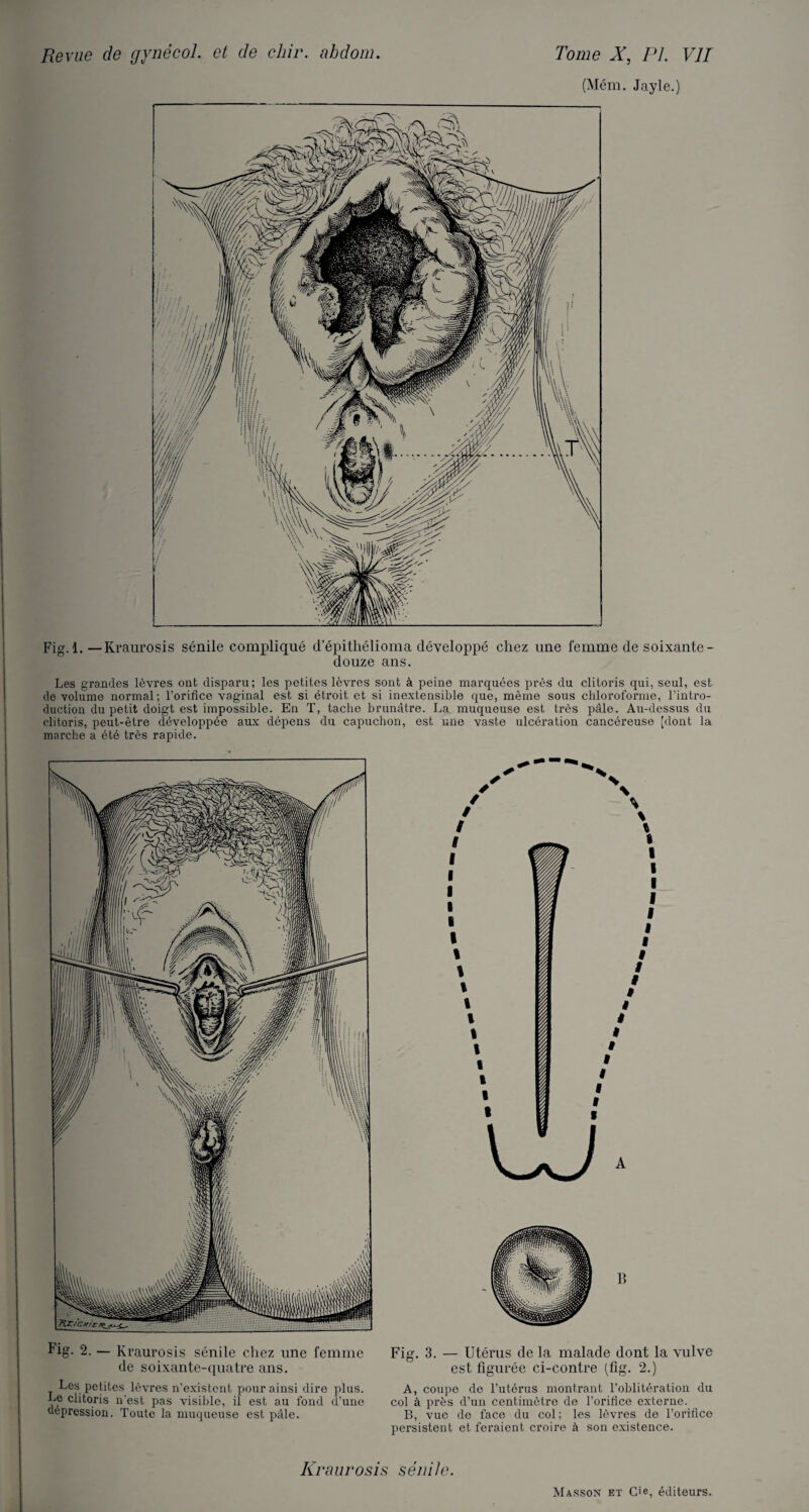 (Mém. Jayle.) Fig. 1. — Kraurosis sénile compliqué depithélioma développé chez une femme de soixante - douze ans. Les grandes lèvres ont disparu; les petites lèvres sont à peine marquées près du clitoris qui, seul, est de volume normal; l’orifice vaginal est si étroit et si inextensible que, même sous chloroforme, l'intro¬ duction du petit doigt est impossible. En T, tache brunâtre. La muqueuse est très pâle. Au-dessus du clitoris, peut-être développée aux dépens du capuchon, est une vaste ulcération cancéreuse [dont la marche a été très rapide. Fig. 2. — Kraurosis sénile chez une femme de soixante-quatre ans. Les petites lèvres n’existent pour ainsi dire plus. Le clitoris n’est pas visible, il est au fond d’une dépression. Toute la muqueuse est pâle. Fig. 3. — Utérus de la malade dont la vulve est figurée ci-contre (fig. 2.) A, coupe de l’utérus montrant l’oblitération du col à près d’un centimètre de l’orifice externe. B, vue de face du col; les lèvres de l’orifice persistent et feraient croire à son existence. Kraurosis sénile.