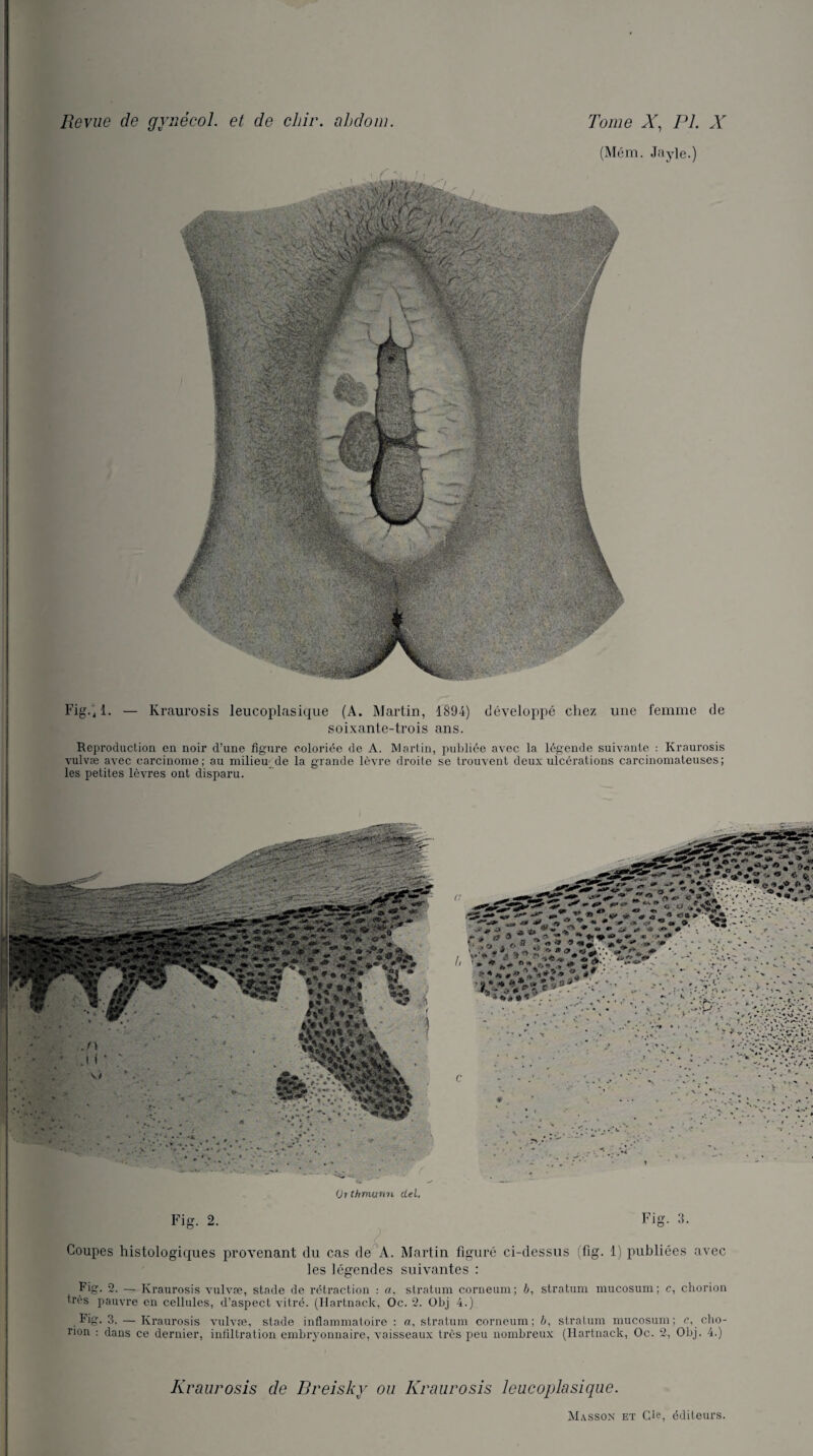 (Mém. Jayle.) Fig., 1. — Ivraurosis leucoplasique (A. Martin, 1894) développé chez une femme de soixante-trois ans. Reproduction en noir d’une figure coloriée de A. Martin, publiée avec la légende suivante : Ivraurosis vulvæ avec carcinome; au milieu de la grande lèvre droite se trouvent deux ulcérations carcinomateuses; les petites lèvres ont disparu. (Ji thmun-n del. Fig. 2. Fig. 3. Coupes histologiques provenant du cas de A. Martin figuré ci-dessus (fig. 1) publiées avec les légendes suivantes : Fig. 2. — Ivraurosis vulvæ, stade de rétraction : a, stratum corneum; b, stratum mucosum; c, chorion très pauvre en cellules, d’aspect vitré. (Ilartnack, Oc. 2. Obj 4.) Fig. 3. — Ivraurosis vulvæ, stade inflammatoire : a, stratum corneum; b, stratum mucosum; c, cho- non : dans ce dernier, infiltration embryonnaire, vaisseaux très peu nombreux (Ilartnack, Oc. 2, Obj. 4.) Kraurosis de Breisky ou Kraurosis leucoplasique.