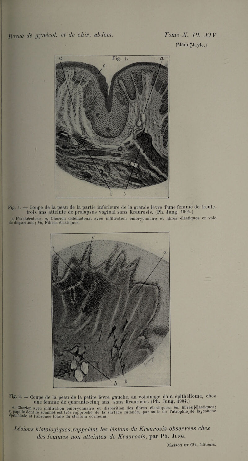 (Mém.*Jayle.) Fig. 1. — Coupe de la peau de la partie inférieure de la grande lèvre d’une femme de trente- trois ans atteinte de prolapsus vaginal sans Kraurosis. (Ph. Jung, 1904.) c, Parakératose ; a, Chorion œdémateux, avec infiltration embryonnaire et fibres élasticpies envoie de disparition ; bb, Fibres élastiques. Fig. 2. — Coupe de la peau de la petite lèvre gauche, au voisinage d'un épithélioma, chez une femme de quarante-cinq ans, sans Kraurosis. (Ph. Jung, 1904.) a, Chorion avec infiltration embryonnaire et disparition des fibres élastiques; bb, fibres [élastiques ; c, papille dont le sommet est très rapproché de la surface cutanée, ipar suite de l’atrophiejde lajcouche epithéliale et l’absence totale du stratum corneum. Lésions histologiques.rappelant les lésions du Kraurosis observées chez des femmes non atteintes de Kraurosis, par Ph. Jung.