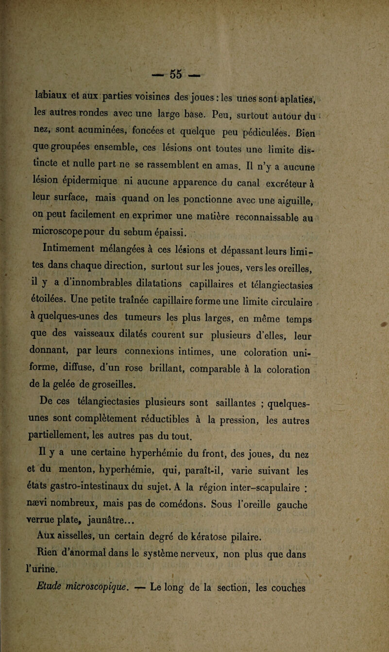 labiaux et aux parties voisines des joues : les unes sont aplatiés, les autres rondes avec une large base. Peu, surtout autour du nez, sont acuminées, foncées et quelque peu pédiculées. Bien que groupées ensemble, ces lésions ont toutes une limite dis¬ tincte et nulle part ne se rassemblent en amas. Il n’y a aucune lésion épidermique ni aucune apparence du canal excréteur à leur surface, mais quand on les ponctionne avec une aiguille, on peut facilement en exprimer une matière reconnaissable au microscope pour du sébum épaissi. Intimement mélangées à ces lésions et dépassant leurs limi¬ tes dans chaque direction, surtout sur les joues, vers les oreilles, il y a d’innombrables dilatations capillaires et télangiectasies étoilées. Une petite traînée capillaire forme une limite circulaire à quelques-unes des tumeurs les plus larges, en même temps que des vaisseaux dilatés courent sur plusieurs d’elles, leur donnant, par leurs connexions intimes, une coloration uni¬ forme, diffuse, d’un rose brillant, comparable à la coloration de la gelée de groseilles. De ces telangiectasies plusieurs sont saillantes ; quelques- unes sont complètement réductibles à la pression, les autres partiellement, les autres pas du tout. Il y a une certaine hyperhémie du front, des joues, du nez et du menton, hyperhémie, qui, paraît-il, varie suivant les états gastro-intestinaux du sujet. A la région inter-scapulaire : nævi nombreux, mais pas de comédons. Sous l’oreille gauche verrue plate, jaunâtre... Aux aisselles, un certain degré de kératose pilaire. Rien d’anormal dans le système nerveux, non plus que dans l’urine. Etude microscopique. — Le long de la section, les couches