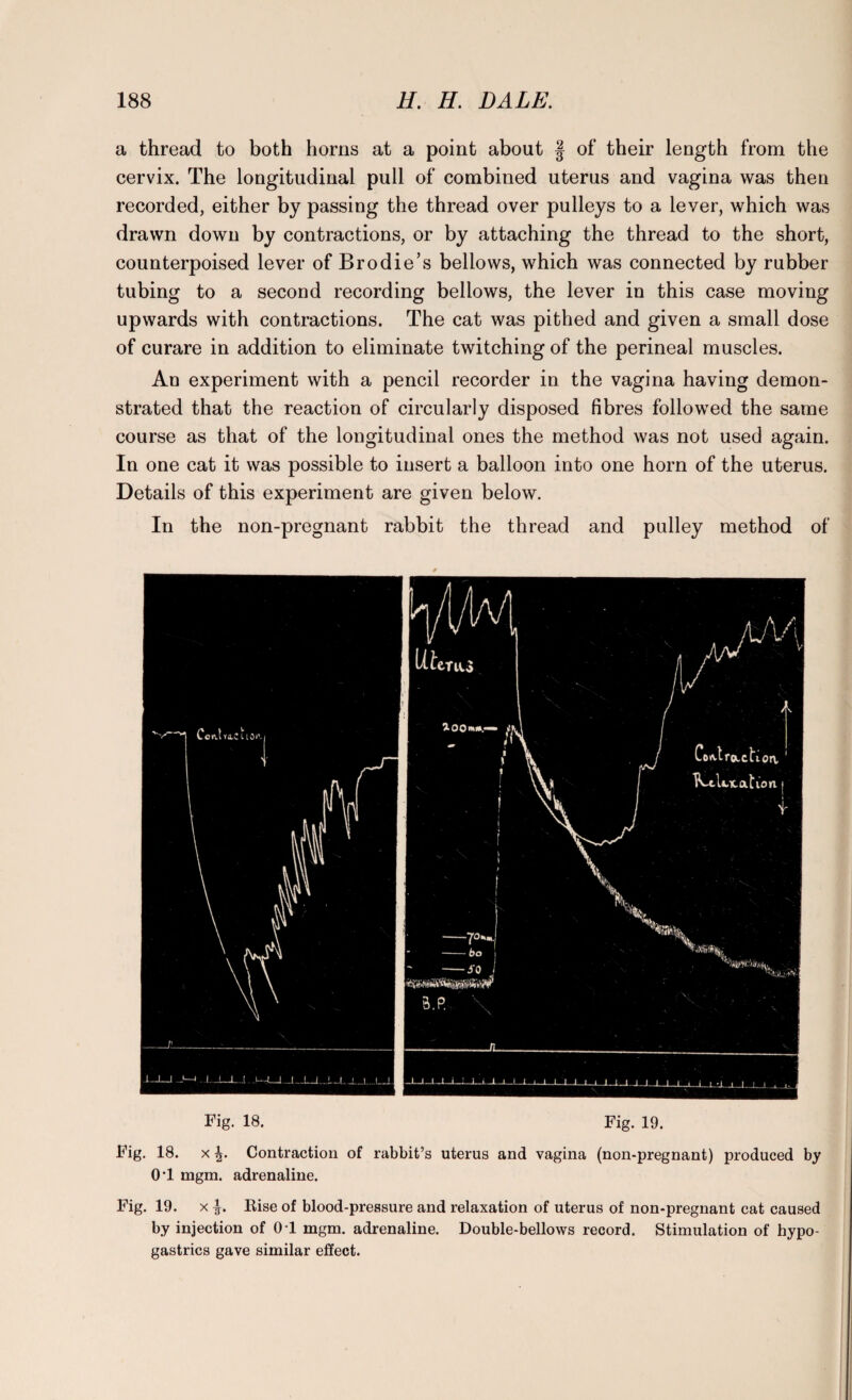 a thread to both horns at a point about § of their length from the cervix. The longitudinal pull of combined uterus and vagina was then recorded, either by passing the thread over pulleys to a lever, which was drawn down by contractions, or by attaching the thread to the short, counterpoised lever of Brodie’s bellows, which was connected by rubber tubing to a second recording bellows, the lever in this case moving upwards with contractions. The cat was pithed and given a small dose of curare in addition to eliminate twitching of the perineal muscles. An experiment with a pencil recorder in the vagina having demon¬ strated that the reaction of circularly disposed fibres followed the same course as that of the longitudinal ones the method was not used again. In one cat it was possible to insert a balloon into one horn of the uterus. Details of this experiment are given below. In the non-pregnant rabbit the thread and pulley method of Fig. 18. Fig. 19. Fig. 18. x Contraction of rabbit’s uterus and vagina (non-pregnant) produced by 0‘1 mgm. adrenaline. Fig. 19. x Rise of blood-pressure and relaxation of uterus of non-pregnant cat caused by injection of 0 1 mgm. adrenaline. Double-bellows record. Stimulation of hypo- gastrics gave similar effect.