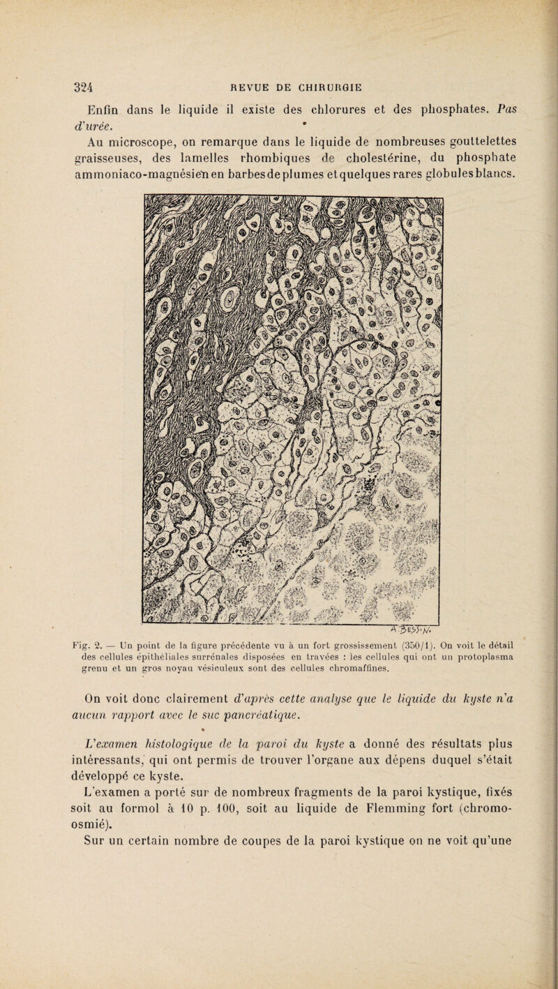 Enfin dans le liquide il existe des chlorures et des phosphates. Pas d'urée. Au microscope, on remarque dans le liquide de nombreuses gouttelettes graisseuses, des lamelles rhombiques de cholestérine, du phosphate ammoniaco-magnésie'nen barbesdeplumes etquelquesrares globulesblancs. Fig. 2. — Un point de la figure précédente vu à un fort grossissement (350/1). On voit le détail des cellules épithéliales surrénales disposées en travées : les cellules qui ont un protoplasma grenu et un gros noyau vésiculeux sont des cellules chromaffines. On voit donc clairement d'après cette analyse que le liquide du kyste n'a aucun rapport avec le suc pancréatique. L'examen histologique de la paroi du kyste a donné des résultats plus intéressants, qui ont permis de trouver l’organe aux dépens duquel s’était développé ce kyste. L'examen a porté sur de nombreux fragments de la paroi kystique, fixés soit au formol à 10 p. 100, soit au liquide de Flemming fort (chromo- osmié). Sur un certain nombre de coupes de la paroi kystique on ne voit qu’une