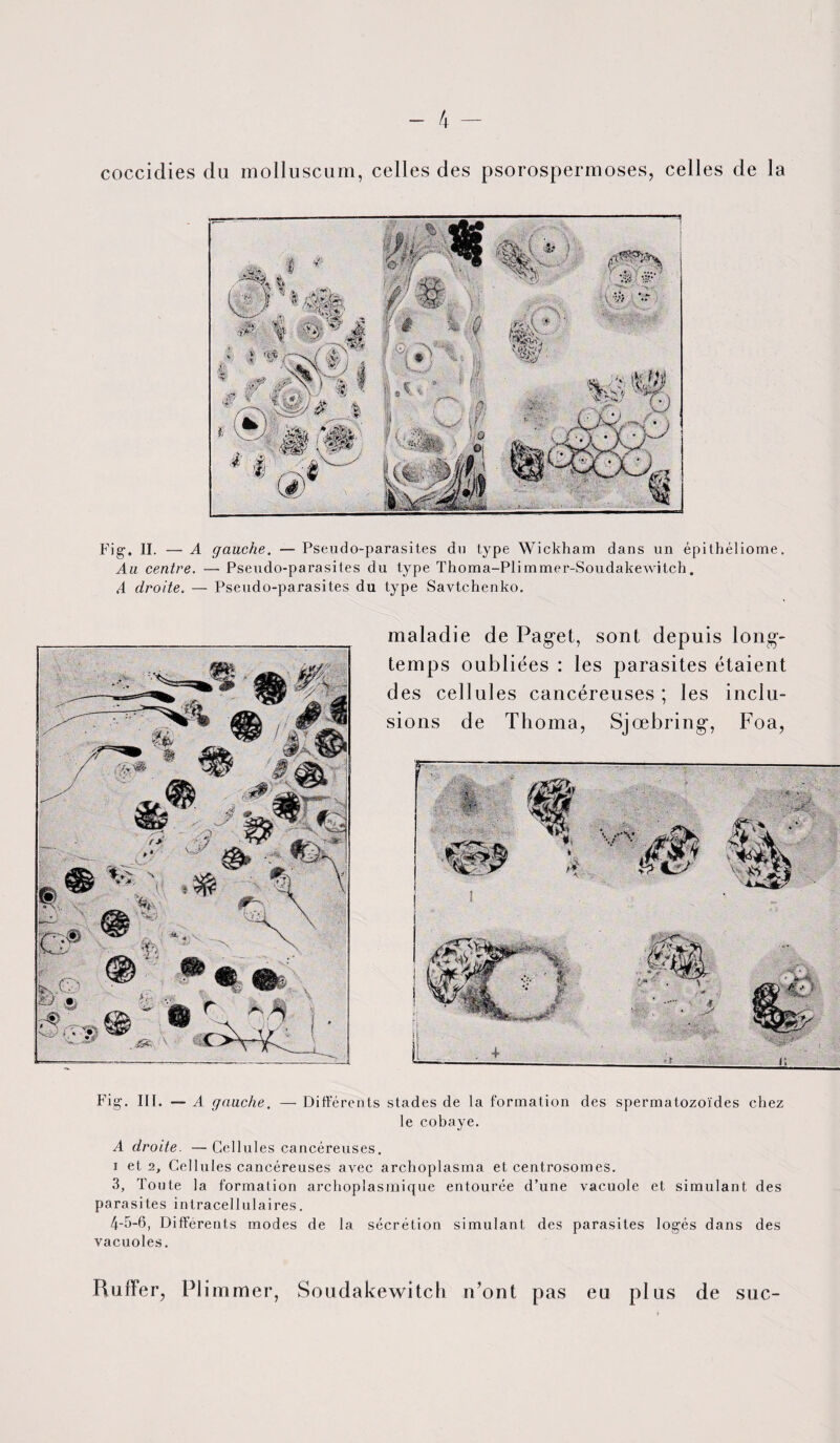 coccidies du molluscum, celles des psorospermoses, celles de la Fig1. II. — A gauche. — Pseudo-parasites du type Wickham dans un épithéliome. Au centre. —- Pseudo-parasites du type Thoma-Plimmer-Soudakewitch. A droite. — Pseudo-parasites du type Savtchenko. maladie de Paget, sont depuis long¬ temps oubliées : les parasites étaient des cellules cancéreuses ; les inclu¬ sions de Thoma, Sjœbring, Foa, Fig. III. — A gauche. — Différents stades de la formation des spermatozoïdes chez le cobaye. A droite. — Cellules cancéreuses. i et 2, Cellules cancéreuses avec archoplasma et centrosomes. 3, Toute la formation archoplasmique entourée d’une vacuole et simulant des parasites intracellulaires. 4-5-6, Différents modes de la sécrétion simulant des parasites logés dans des vacuoles. Huiler, PI immer, Soudakewitch n’ont pas eu plus de suc-