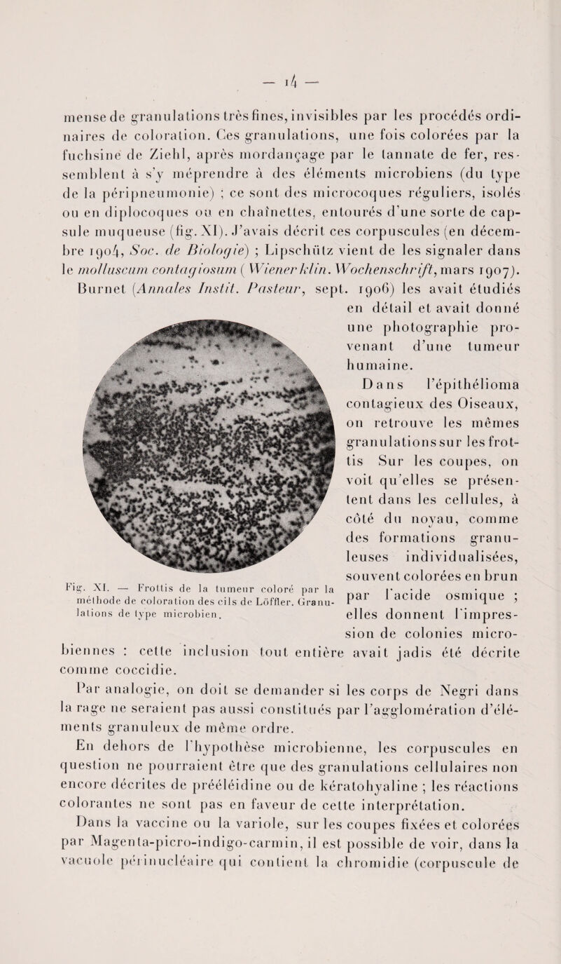 mensede granulations très fines, invisibles par les procédés ordi¬ naires de coloration. Ces granulations, une fois colorées par la fuchsine de Ziehl, après mordançage par le lannate de fer, res¬ semblent à s’y méprendre à des éléments microbiens (du type de la péripneumonie) ; ce sont des microcoques réguliers, isolés ou en diplocoques ou en chaînettes, entourés d’une sorte de cap¬ sule muqueuse (fig. XI). J’avais décrit ces corpuscules (en décem¬ bre rqo4, Soc. de Biologie) ; Lipscluïtz vient de les signaler dans le molluscam contagiosum ( Wiener klin. Wochenschrift, mars 1907). Burnet (Annales Instit. Pasteur, sept. 1906) les avait étudiés en détail et avait donné une photographie pro¬ venant d’une tumeur humaine. Dans l’épi thélioma contagieux des Oiseaux, on retrouve les mêmes granulations sur les frot¬ tis Sur les coupes, on voit qu elles se présen¬ tent dans les cellules, à côté du noyau, comme des formations granu¬ leuses individualisées, souvent colorées en brun par l'acide osmique ; elles donnent l'impres¬ sion de colonies micro¬ biennes : cette inclusion tout entière avait jadis été décrite comme coccidie. Par analogie, on doit se demander si les corps de Negri dans la rage ne seraient pas aussi constitués par l'agglomération d’élé¬ ments granuleux de même ordre. En dehors de 1 hypothèse microbienne, les corpuscules en question ne pourraient être que des granulations cellulaires non encore décrites de prééléidine ou de kératohyaline ; les réactions colorantes ne sont pas en faveur de cette interprétation. Dans la vaccine ou la variole, sur les coupes fixées et colorées par Magenta-picro-indigo-carmin, il est possible de voir, dans la vacuole péi inucléaire qui contient la cliromidie (corpuscule de Hg\ XI. — Frottis de la tumeur coloré par la méthode de coloration des cils de Lôffler. Granu¬ lations de type microbien.