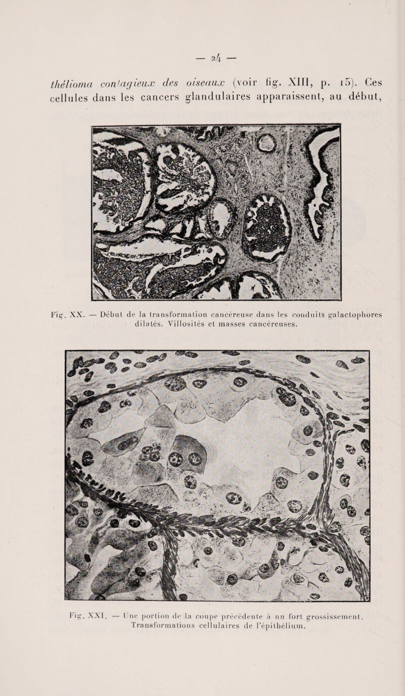 2 4 thélioma contagieux des oiseaux (voir fig. XIII, p. i5). Ces cellules dans les cancers glandulaires apparaissent, au début, Fig. XX. Début de la transformation cancéreuse dans les conduits galactophores dilatés. Villosités et masses cancéreuses. ,'X? \ U Fig. XXI . — U ne portion de la coupe précédente à un fort grossissement. Transformations cellulaires de l’épithélium.