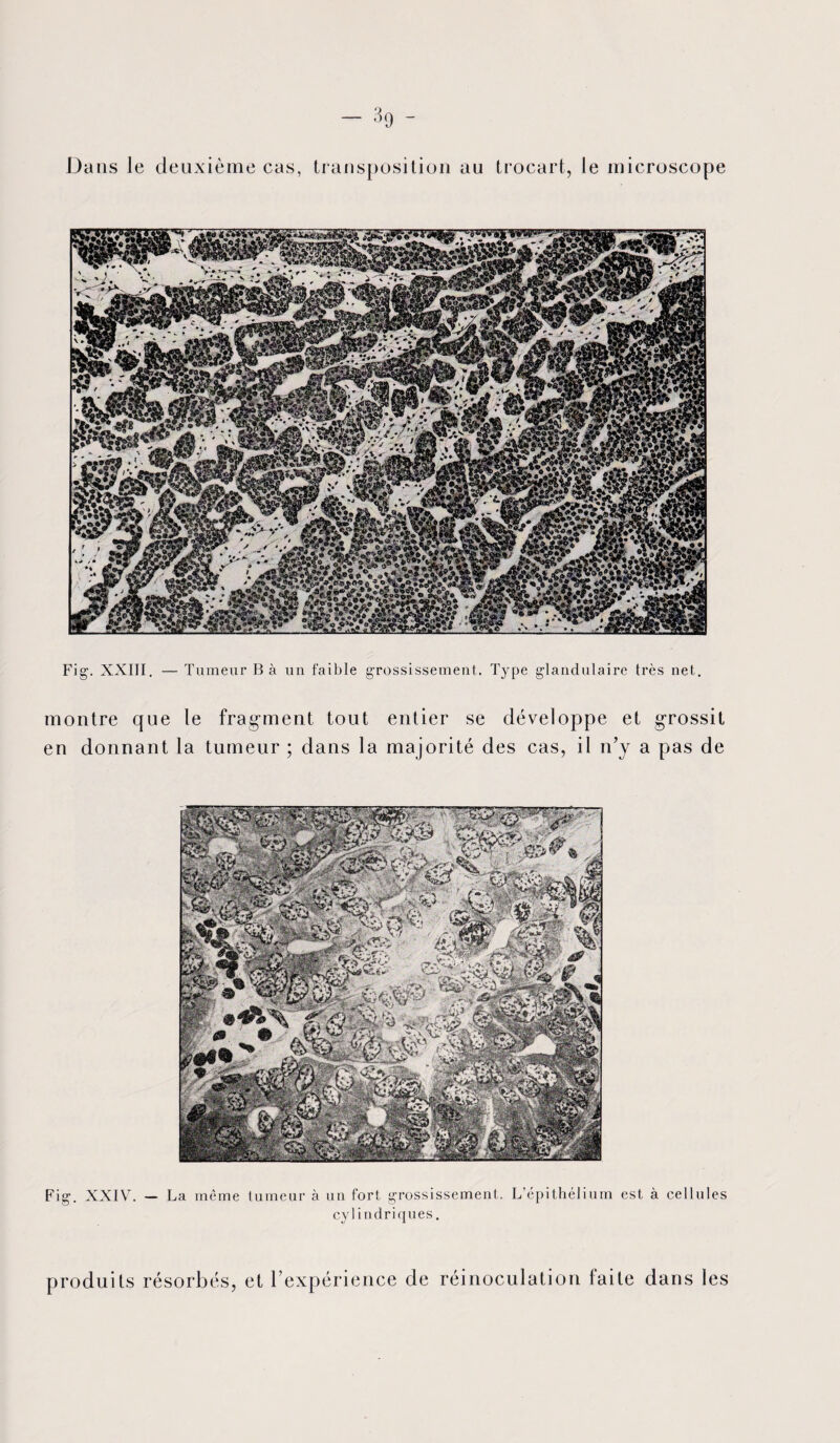 Dans le deuxième cas, transposition au trocart, le microscope Fig. XXIII. — Tumeur B à un faible grossissement. Type glandulaire très net. montre que le fragment tout entier se développe et grossit en donnant la tumeur ; dans la majorité des cas, il n’y a pas de Fig. XXIYL — La même tumeur à un fort grossissement. L’épithélium est à cellules cylindriques. produits résorbés, et l’expéri ence de réinoculation faite dans les