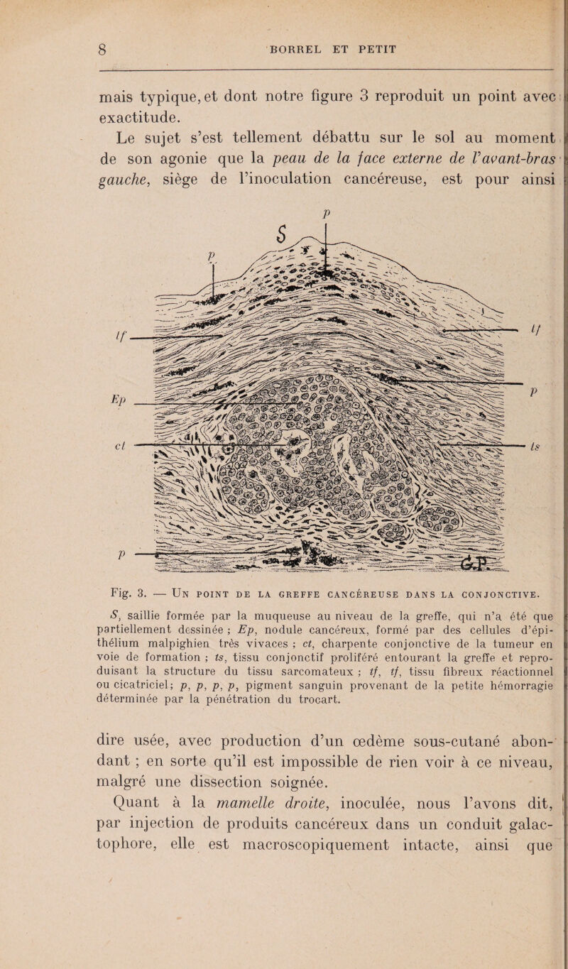 dire usée, avec production d’un œdème sous-cutané abon¬ dant ; en sorte qu’il est impossible de rien voir à ce niveau, malgré une dissection soignée. Quant à la mamelle droite, inoculée, nous l’avons dit, par injection de produits cancéreux dans un conduit galac- tophore, elle est macroscopiquement intacte, ainsi que mais typique, et dont notre figure 3 reproduit un point avec « exactitude. Le sujet s’est tellement débattu sur le sol au moment if de son agonie que la peau de la face externe de Vavant-bras gauche, siège de l’inoculation cancéreuse, est pour ainsi Fig. 3. — Un point de la greffe cancéreuse dans la conjonctive. S, saillie formée par la muqueuse au niveau de la greffe, qui n5a été que partiellement dessinée ; Ep, nodule cancéreux, formé par des cellules d’épi¬ thélium malpighien très vivaces ; et, charpente conjonctive de la tumeur en voie de formation ; ts, tissu conjonctif proliféré entourant la greffe et repro¬ duisant la structure du tissu sarcomateux ; tf, tf, tissu fibreux réactionnel ou cicatriciel; p, p, p, p, pigment sanguin provenant de la petite hémorragie déterminée par la pénétration du trocart.