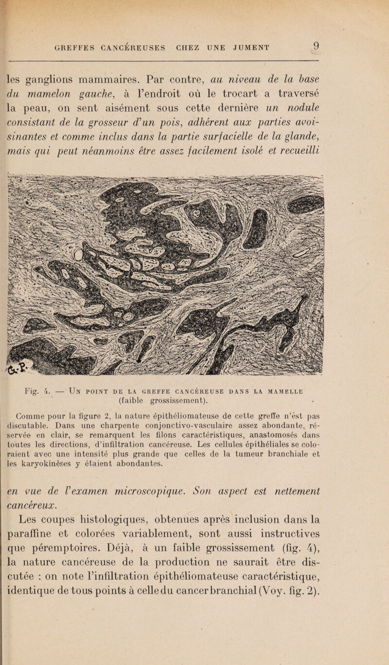 les ganglions mammaires. Par contre, au niveau de la base du mamelon gauche, à l’endroit où le trocart a traversé la peau, on sent aisément sous cette dernière un nodule consistant de la grosseur d'un pois, adhérent aux parties avoi¬ sinantes et comme inclus dans la partie surfacielle de la glande, mais qui peut néanmoins être assez facilement isolé et recueilli Fig. 4. — Un point de la greffe cancéreuse dans la mamelle (faible grossissement). Comme pour la figure 2, la nature épithéliomateuse de cette greffe n’ést pas discutable. Dans une charpente conjonctivo-vasculaire assez abondante, ré¬ servée en clair, se remarquent les filons caractéristiques, anastomosés dans toutes les directions, d’infiltration cancéreuse. Les cellules épithéliales se colo¬ raient avec une intensité plus grande que celles de la tumeur branchiale et les karyokinèses y étaient abondantes. en vue de Vexamen microscopique. Son aspect est nettement cancéreux. Les coupes histologiques, obtenues après inclusion dans la paraffine et colorées variablement, sont aussi instructives que péremptoires. Déjà, à un faible grossissement (fig. 4), la nature cancéreuse de la production ne saurait être dis¬ cutée : on note l’inffitration épithéliomateuse caractéristique, identique de tous points à celle du cancer branchial (Voy. fig. 2).