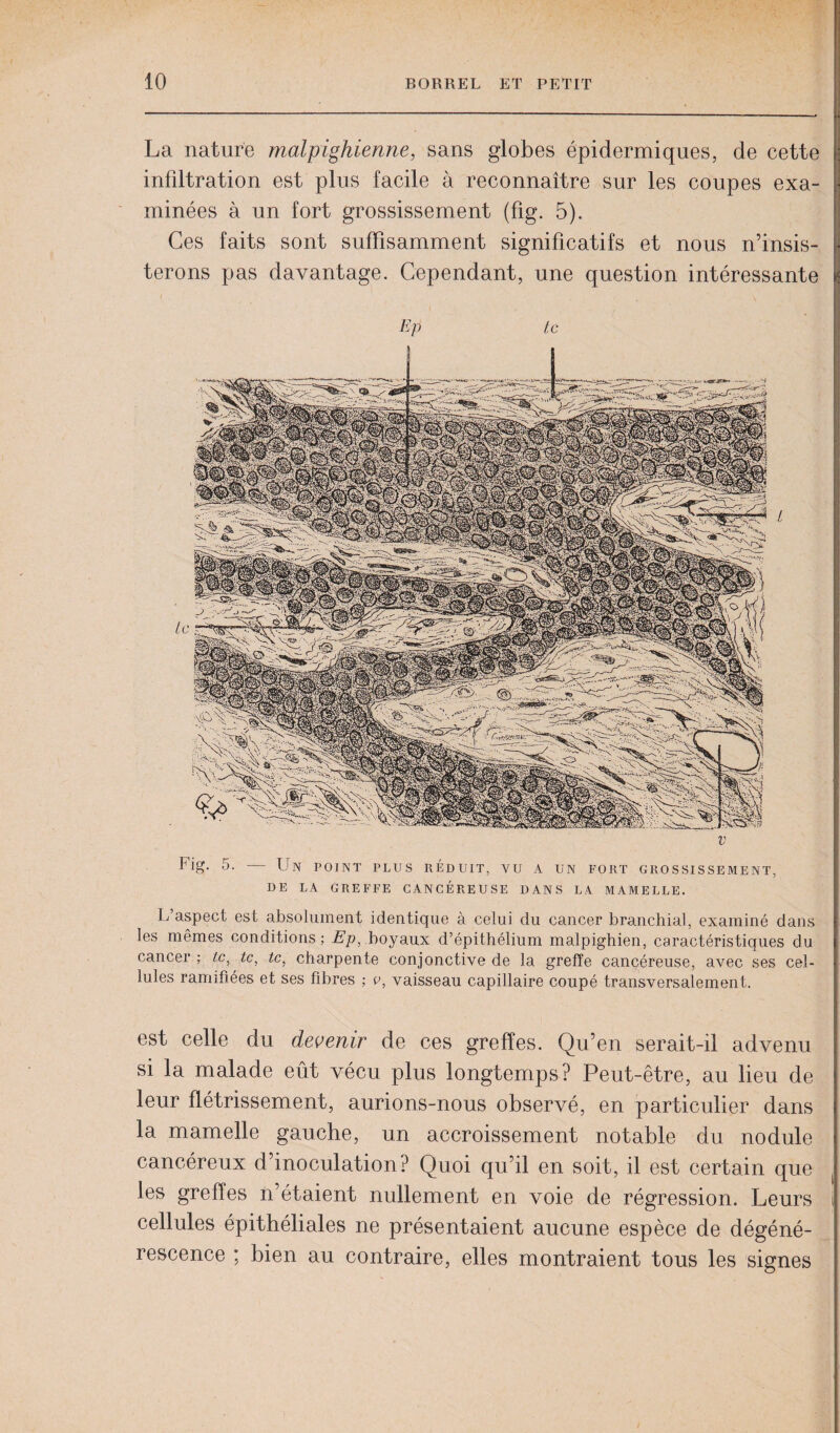 La nature malpighienne, sans globes épidermiques, de cette infiltration est plus facile à reconnaître sur les coupes exa¬ minées à un fort grossissement (fig. 5). Ces faits sont suffisamment significatifs et nous n’insis¬ terons pas davantage. Cependant, une question intéressante Ep te V Fig. 5. — Un point plus réduit, vu a un fort grossissement, DE LA GREFFE CANCÉREUSE DANS LA MAMELLE. L’aspect est absolument identique à celui du cancer branchial, examiné dans les mêmes conditions; Ep, boyaux d’épithélium malpighien, caractéristiques du cancer ; te, te, te, charpente conjonctive de la greffe cancéreuse, avec ses cel¬ lules ramifiées et ses fibres ; v, vaisseau capillaire coupé transversalement. est celle du devenir de ces greffes. Qu’en serait-il advenu si la malade eût vécu plus longtemps? Peut-être, au lieu de leur flétrissement, aurions-nous observé, en particulier dans la mamelle gauche, un accroissement notable du nodule cancéreux d’inoculation? Quoi qu’il en soit, il est certain que les greffes n’étaient nullement en voie de régression. Leurs cellules épithéliales ne présentaient aucune espèce de dégéné¬ rescence ; bien au contraire, elles montraient tous les signes