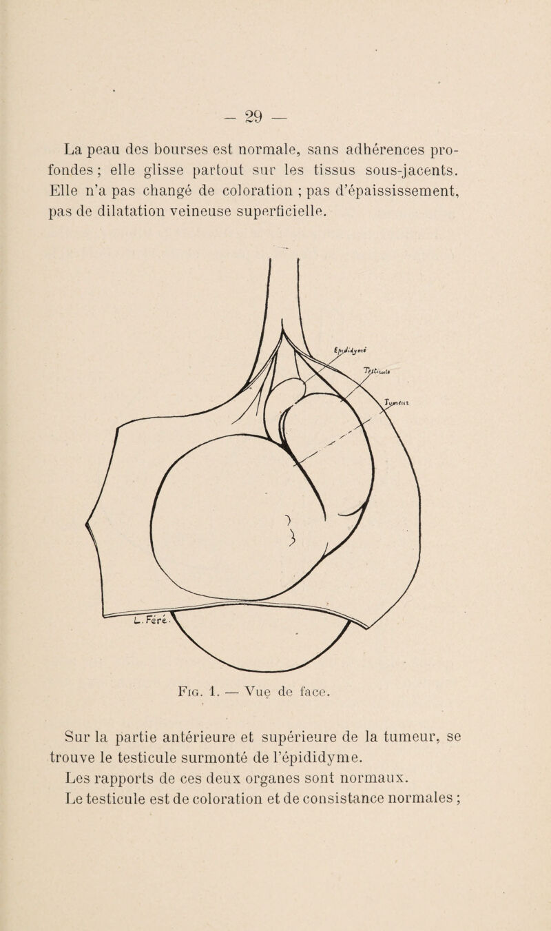 La peau des bourses est normale, sans adhérences pro¬ fondes ; elle glisse partout sur les tissus sous-jacents. Elle n’a pas changé de coloration ; pas d’épaississement, pas de dilatation veineuse superficielle. Sur la partie antérieure et supérieure de la tumeur, se trouve le testicule surmonté de l’épididyme. Les rapports de ces deux organes sont normaux. Le testicule est de coloration et de consistance normales ;