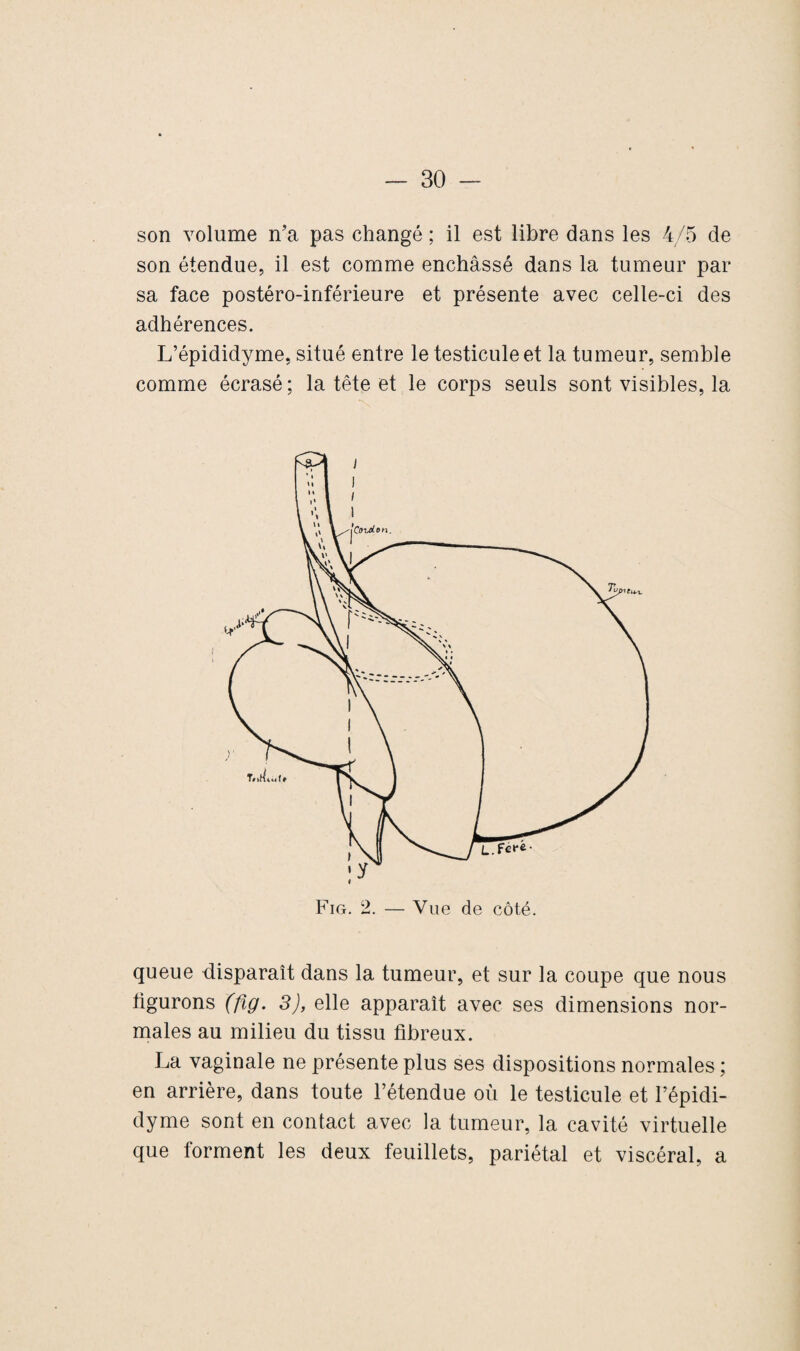 son volume n’a pas changé ; il est libre dans les 4/5 de son étendue, il est comme enchâssé dans la tumeur par sa face postéro-inférieure et présente avec celle-ci des adhérences. L’épididyme, situé entre le testicule et la tumeur, semble comme écrasé ; la tête et le corps seuls sont visibles, la queue disparaît dans la tumeur, et sur la coupe que nous figurons (fig. 3), elle apparaît avec ses dimensions nor¬ males au milieu du tissu fibreux. La vaginale ne présente plus ses dispositions normales ; en arrière, dans toute l’étendue où le testicule et l’épidi- dyme sont en contact avec la tumeur, la cavité virtuelle que forment les deux feuillets, pariétal et viscéral, a