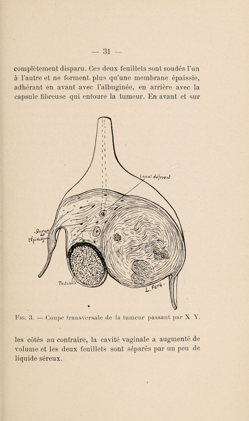 complètement disparu. Ces deux feuillets sont soudés l’un à l’autre et ne forment, plus qu’une membrane épaissie, adhérant en avant avec l’albuginée, en arrière avec la capsule fibreuse qui entoure la tumeur. En avant et sur Fig. 3. — Coupe transversale de la tumeur passant par X Y. les côtés au contraire, la cavité vaginale a augmenté de volume et les deux feuillets sont séparés par un peu de liquide séreux.