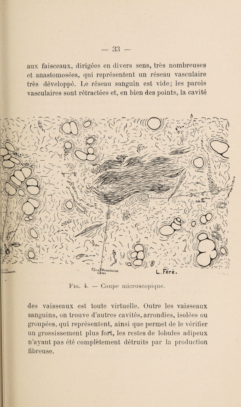 aux faisceaux, dirigées en divers sens, très nombreuses et anastomosées, qni représentent un réseau vasculaire très développé. Le réseau sanguin est vide; les parois vasculaires sont rétractées et, en bien des points, la cavité Fig. 4. — Coupe microscopique. des vaisseaux est toute virtuelle. Outre les vaisseaux sanguins, on trouve d’autres cavités, arrondies, isolées ou groupées, qui représentent, ainsi que permet de le vérifier un grossissement plus fort, les restes de lobules adipeux n’ayant pas été complètement détruits par la production fibreuse.