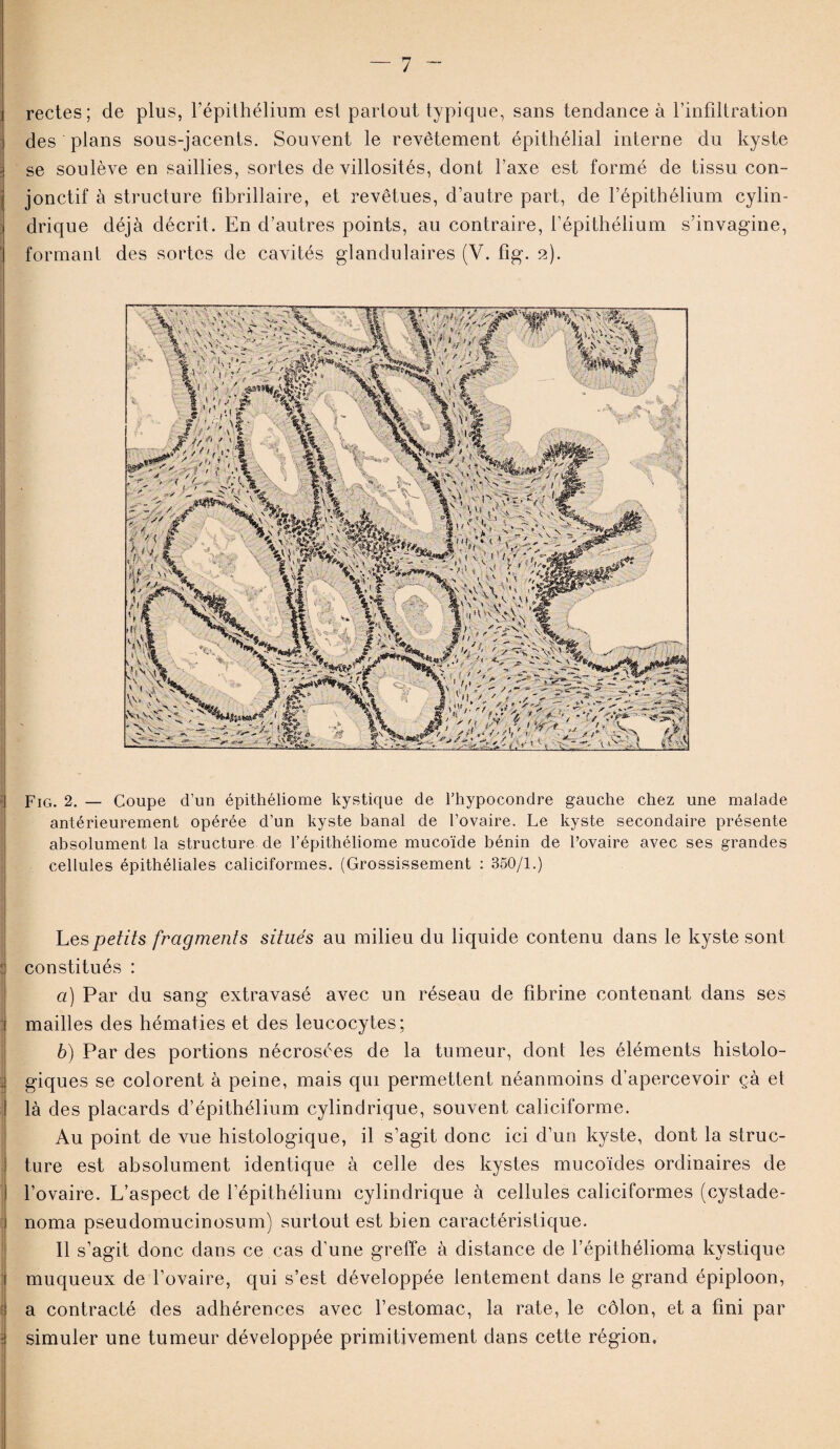 rectes; de plus, l’épithélium est parlout typique, sans tendance à l’infiltration des plans sous-jacents. Souvent le revêtement épithélial interne du kyste se soulève en saillies, sortes de villosités, dont l’axe est formé de tissu con¬ jonctif à structure fibrillaire, et revêtues, d’autre part, de l’épithélium cylin¬ drique déjà décrit. En d’autres points, au contraire, l’épithélium s’invagine, formant des sortes de cavités glandulaires (Y. fig. 2). Fig. 2. — Coupe d’un épithéliome kystique de l’hypocondre gauche chez une malade antérieurement opérée d’un kyste banal de l’ovaire. Le kyste secondaire présente absolument la structure de l’épithéliome mucoïde bénin de l’ovaire avec ses grandes cellules épithéliales caliciformes. (Grossissement : 350/1.) Les petits fragments situés au milieu du liquide contenu dans le kyste sont constitués : a) Par du sang extravasé avec un réseau de fibrine contenant dans ses mailles des hématies et des leucocytes; b) Par des portions nécrosées de la tumeur, dont les éléments histolo¬ giques se colorent à peine, mais qui permettent néanmoins d’apercevoir çà et là des placards d’épithélium cylindrique, souvent caliciforme. Au point de vue histologique, il s’agit donc ici d’un kyste, dont la struc¬ ture est absolument identique à celle des kystes mucoïdes ordinaires de l’ovaire. L’aspect de l’épithélium cylindrique à cellules caliciformes (cystade- noma pseudomucinosum) surtout est bien caractéristique. Il s’agit donc dans ce cas d’une greffe à distance de l’épithélioma kystique muqueux de l’ovaire, qui s’est développée lentement dans le grand épiploon, a contracté des adhérences avec l’estomac, la rate, le côlon, et a fini par simuler une tumeur développée primitivement dans cette région.