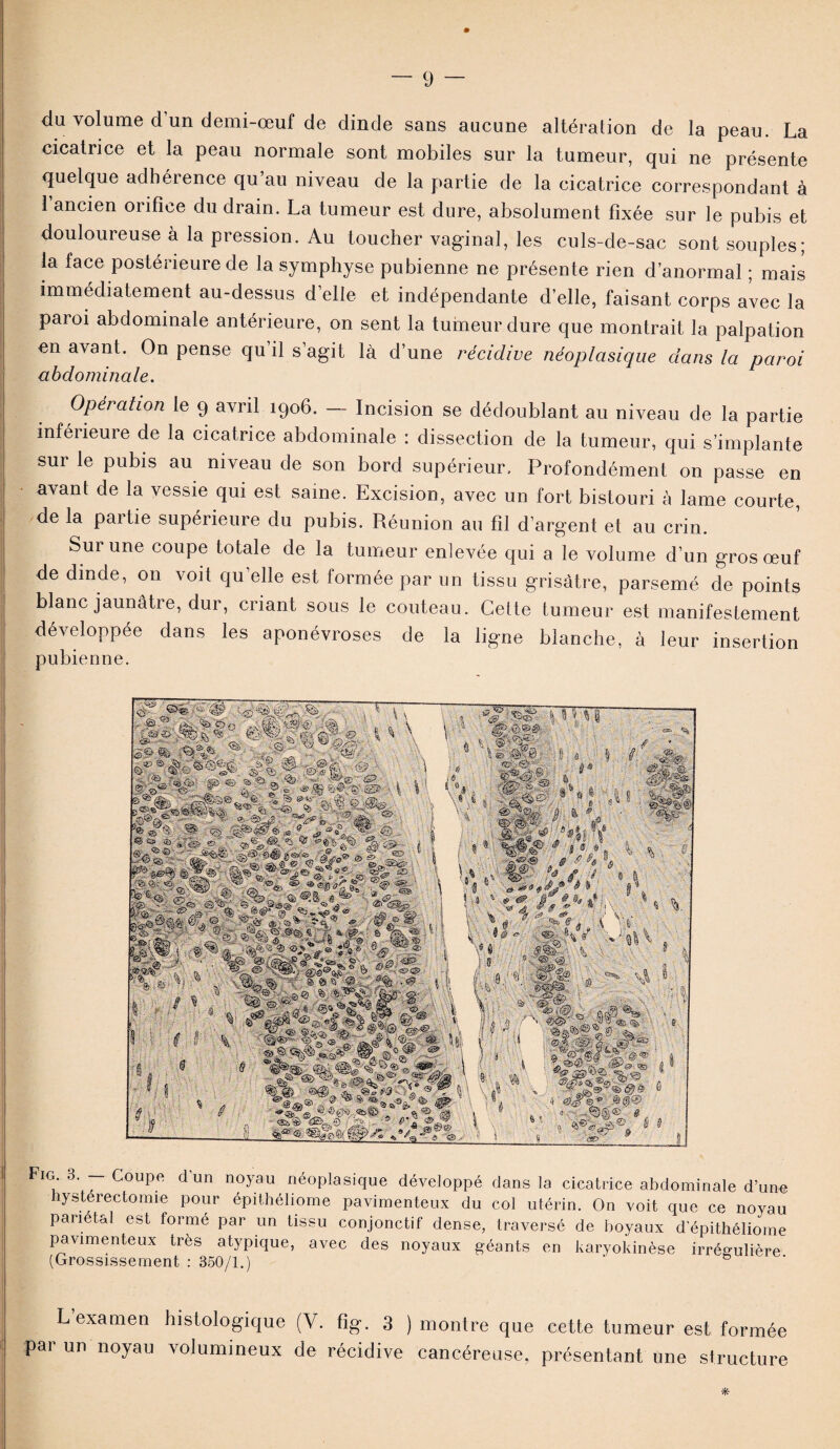 du volume d’un demi-œuf de dinde sans aucune altération de la peau. La cicatrice et la peau normale sont mobiles sur la tumeur, qui ne présente quelque adhérence qu’au niveau de la partie de la cicatrice correspondant à l’ancien orifice du drain. La tumeur est dure, absolument fixée sur le pubis et douloureuse à la pression. Au toucher vaginal, les culs-de-sac sont souples; la face postérieure de la symphyse pubienne ne présente rien d’anormal ; mais immédiatement au-dessus d’elle et indépendante d’elle, faisant corps avec la paroi abdominale antérieure, on sent la tumeur dure que montrait la palpation en avant. On pense qu il s’agit là d’une récidive néoplasique dans la paroi abdominale. Opération le 9 avril 1906. — Incision se dédoublant au niveau de la partie inférieure de la cicatrice abdominale : dissection de la tumeur, qui s’implante sur le pubis au niveau de son bord supérieur. Profondément on passe en avant de la vessie qui est saine. Excision, avec un fort bistouri à lame courte, de la partie supérieure du pubis. Réunion au fil d’argent et au crin. Sur une coupe totale de la tumeur enlevée qui a le volume d’un gros œuf de dinde, on voit qu’elle est formée par un tissu grisâtre, parsemé de points blanc jaunâtre, dur, criant sous le couteau. Cette tumeur est manifestement développée dans les aponévroses de la ligne blanche, à leur insertion pubienne. Fig 3. - Coup* d’un noyau néoplasique développé dans la cicatrice abdominale d’une nysterectomie pour épithéliome pavimenteux du col utérin. On voit que ce noyau pariétal est formé par un tissu conjonctif dense, traversé de boyaux d’épithéliome pavimenteux très atypique, avec des noyaux géants en karyokinèse irrégulière (Grossissement : 350/1.) ' b L examen histologique (V. fig. 3 ) montre que cette tumeur est formée par un noyau volumineux de récidive cancéreuse, présentant une structure